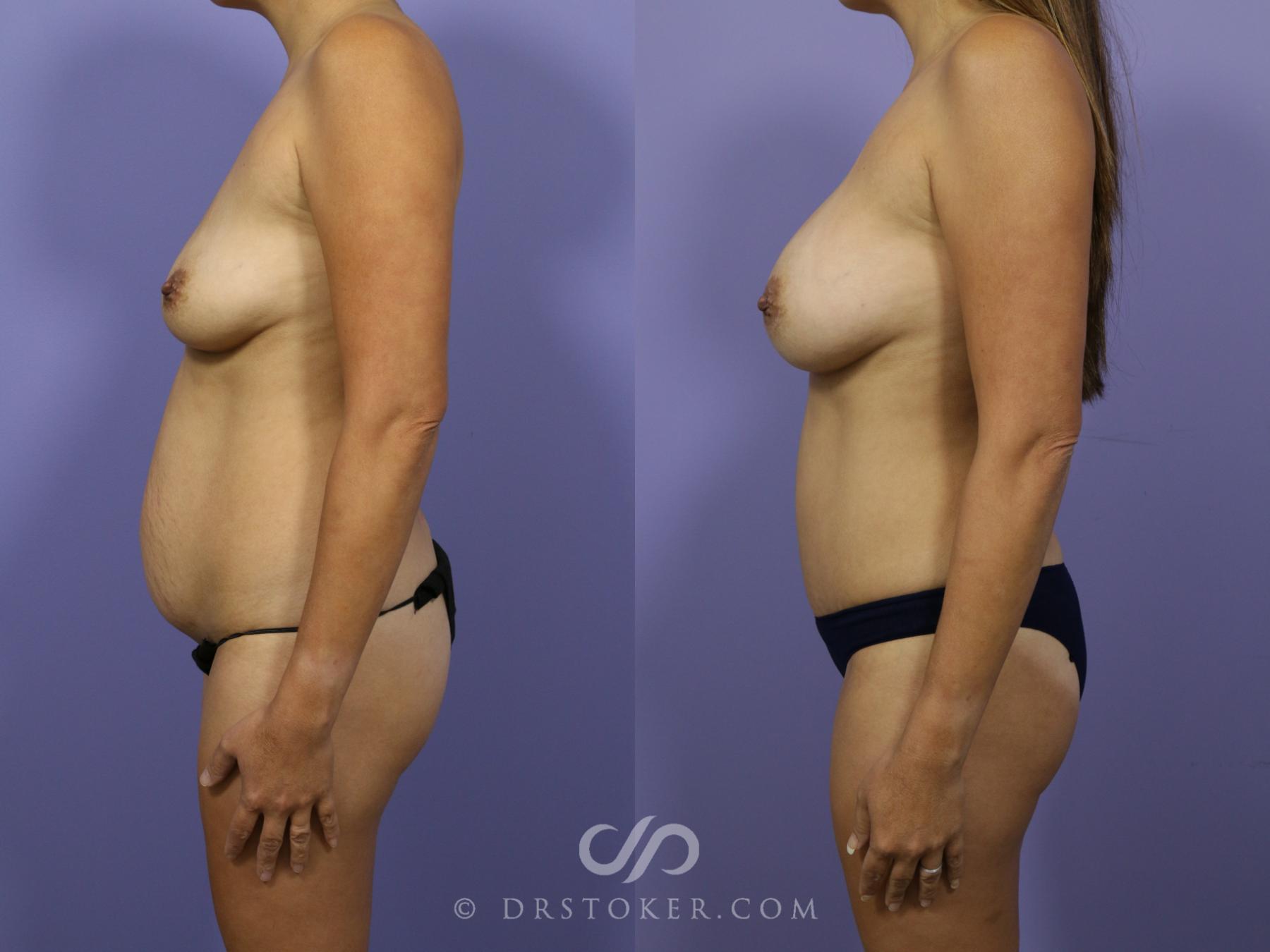 Before & After Mommy Makeover Case 744 View #3 View in Los Angeles, CA