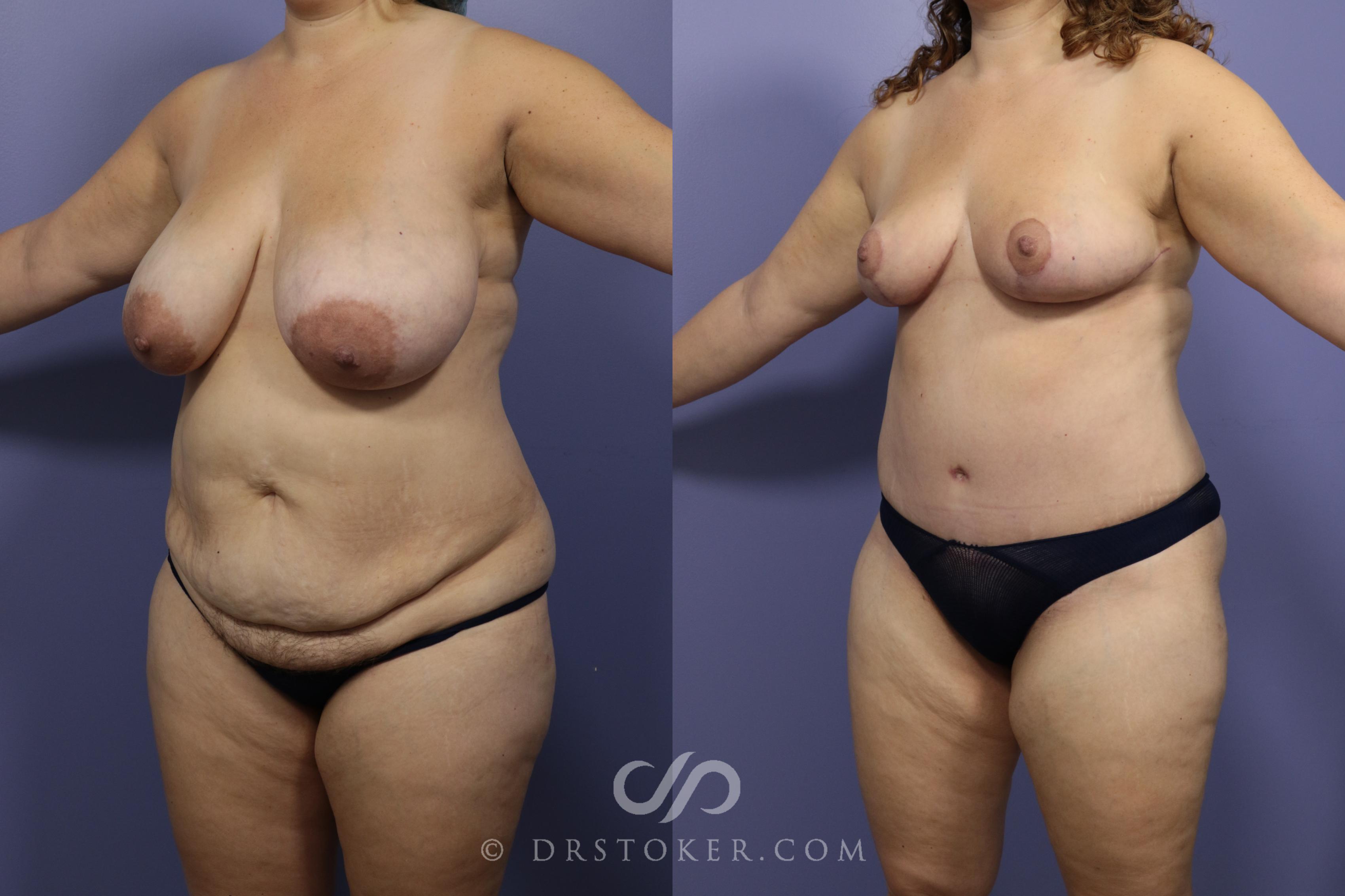 Before & After Mommy Makeover Case 745 View #2 View in Los Angeles, CA.