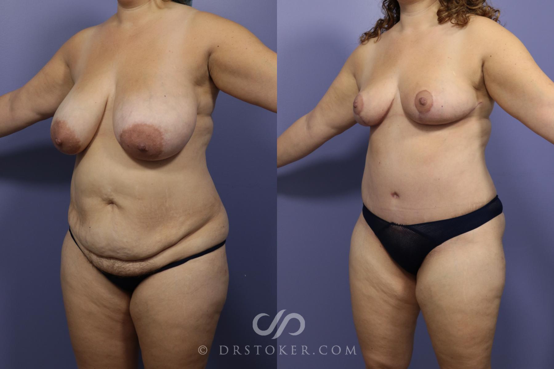 Before & After Mommy Makeover Case 745 View #2 View in Los Angeles, CA