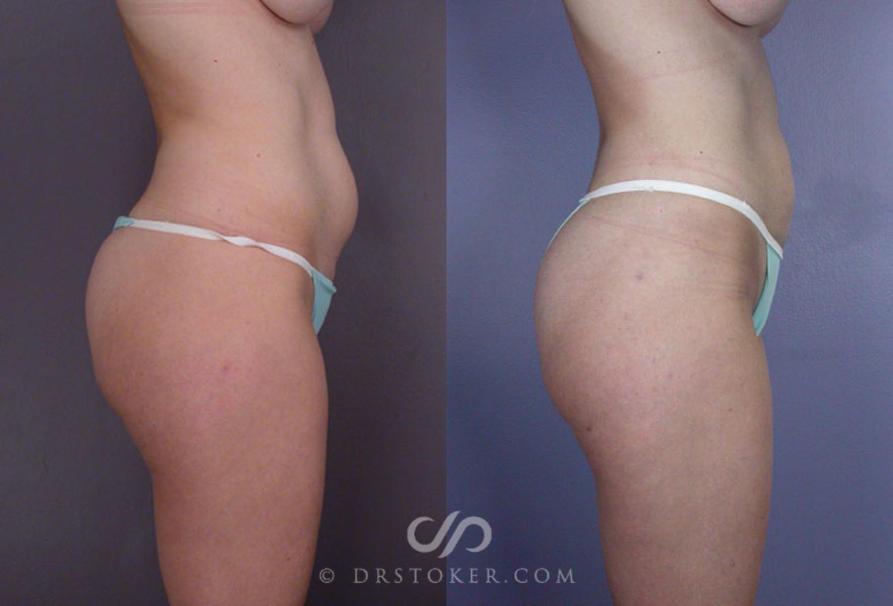 Before & After Liposuction Case 79 View #11 View in Los Angeles, CA