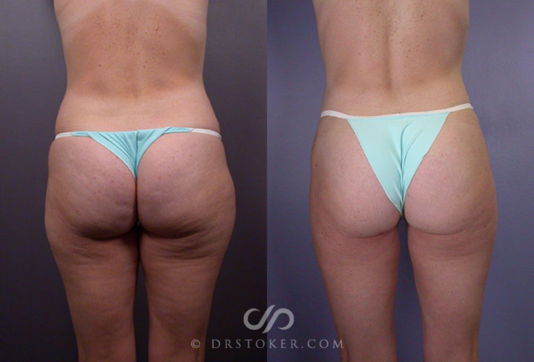 Before & After Liposuction Case 79 View #2 View in Los Angeles, CA