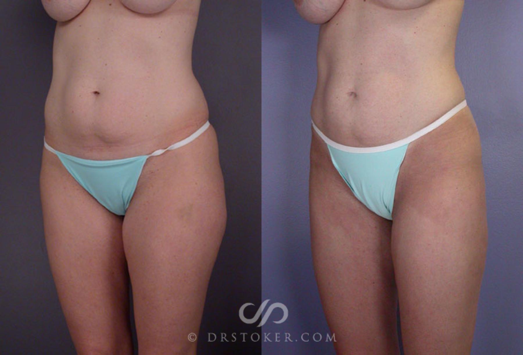 Before & After Liposuction Case 79 View #3 View in Los Angeles, CA