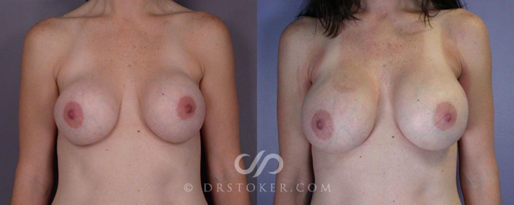 Before & After Liposuction Case 79 View #4 View in Los Angeles, CA