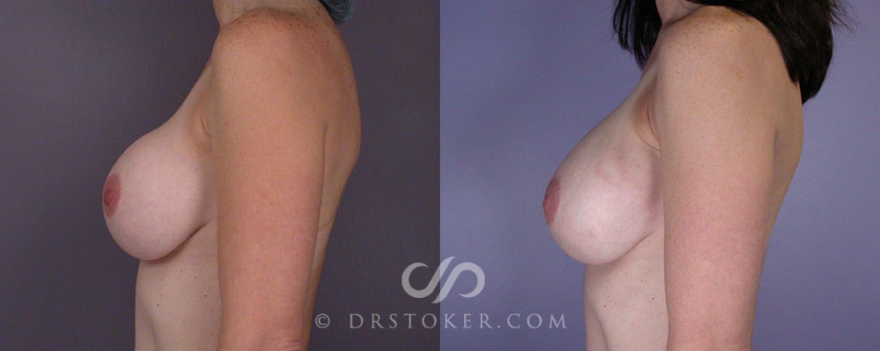Before & After Liposuction Case 79 View #5 View in Los Angeles, CA