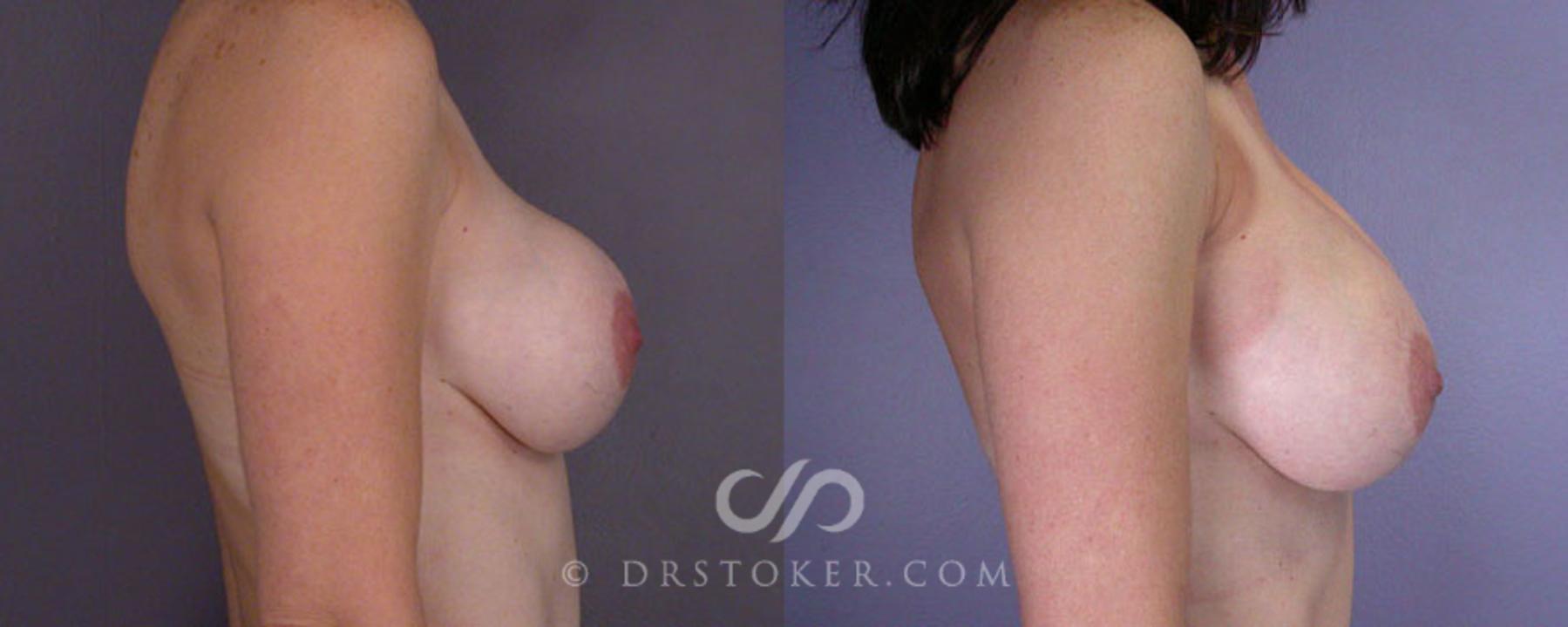 Before & After Liposuction Case 79 View #7 View in Los Angeles, CA