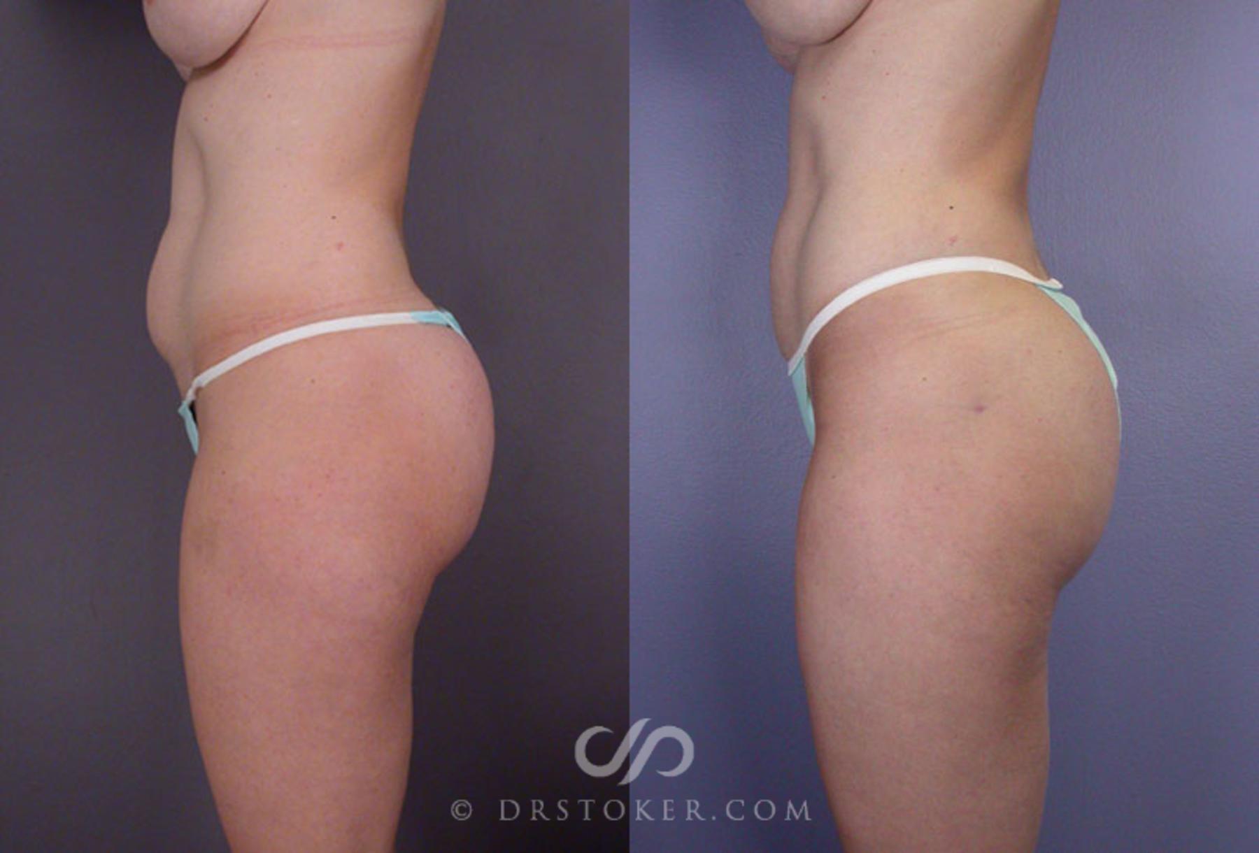 Before & After Liposuction Case 79 View #9 View in Los Angeles, CA