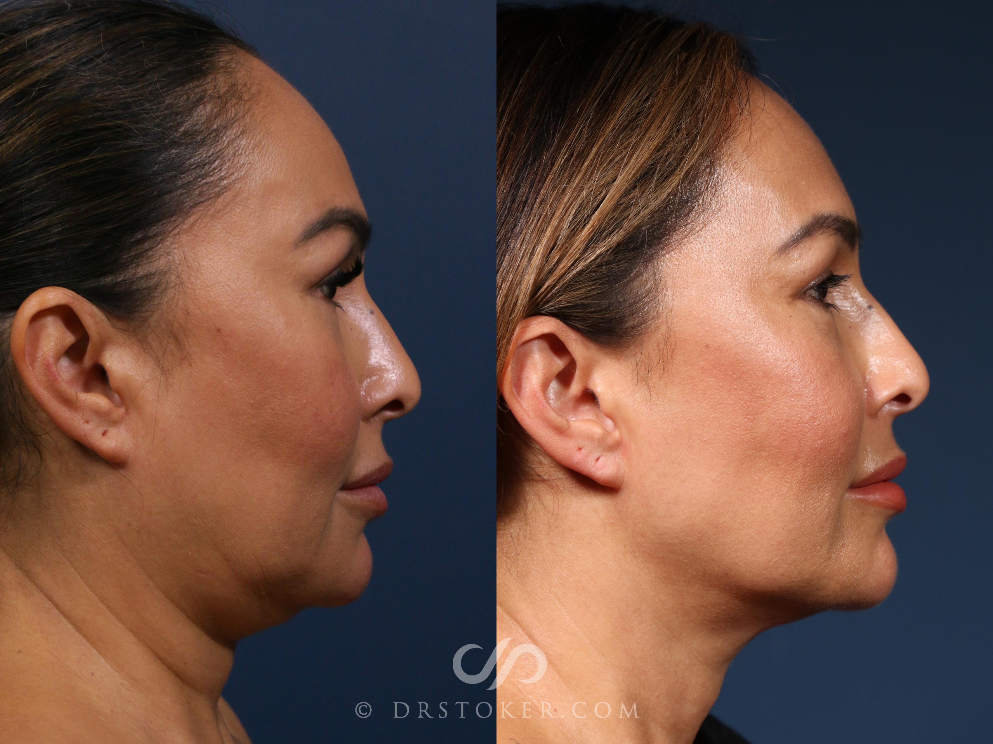 Before & After Morpheus8 Case 2329 Right Side View in Los Angeles, CA