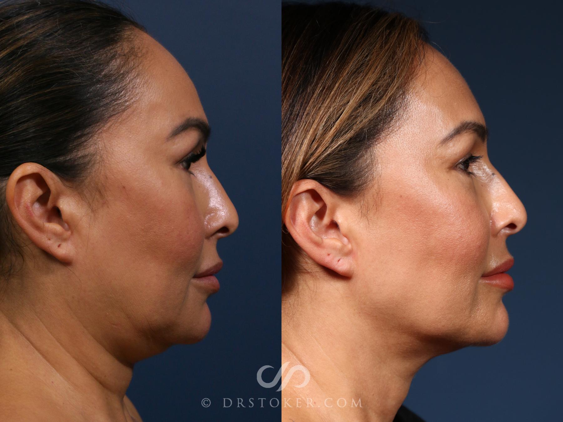 Before & After Morpheus8 Case 2329 Right Side View in Los Angeles, CA