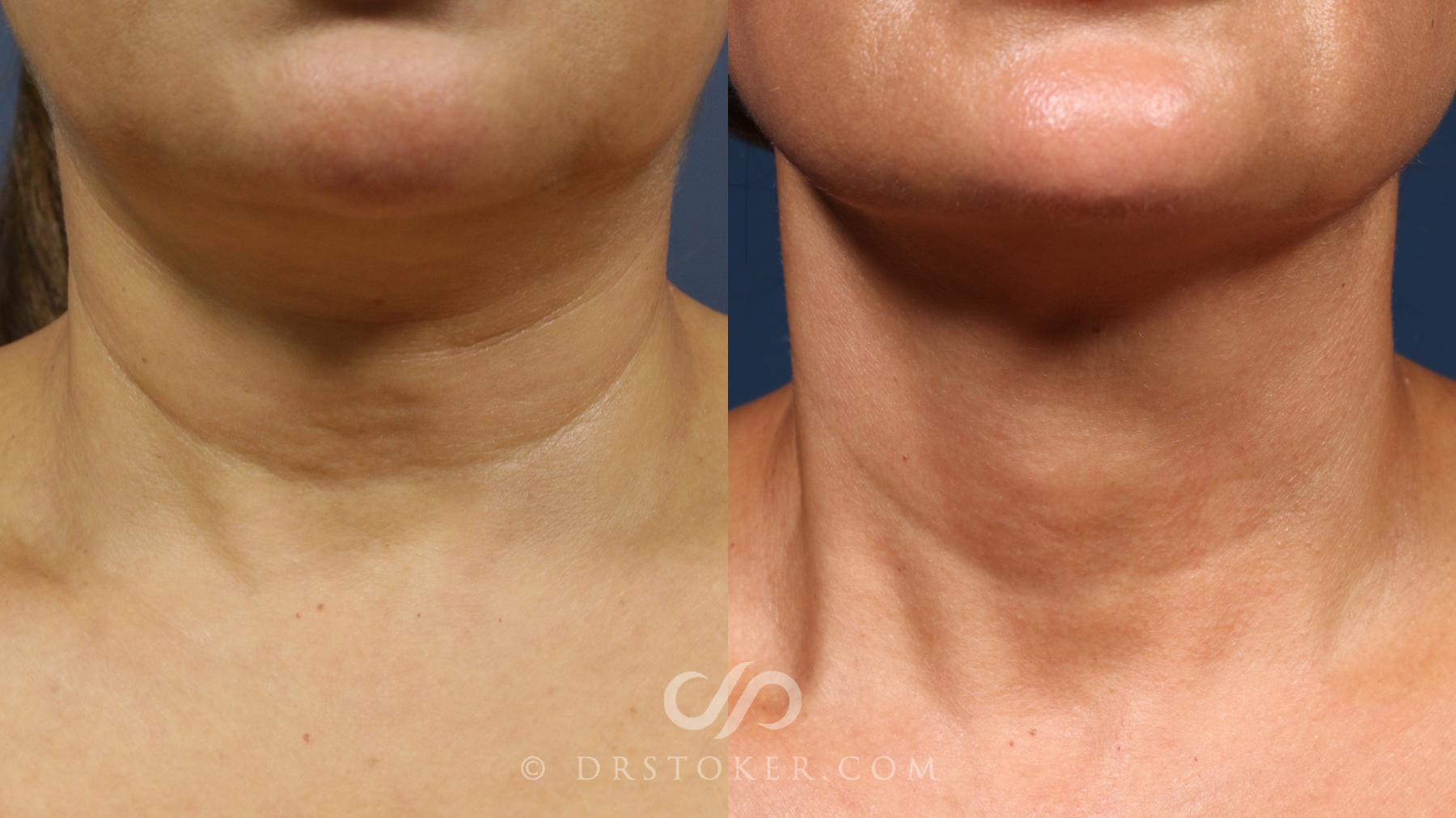 Before & After Morpheus8 Case 2330 Front View in Los Angeles, CA