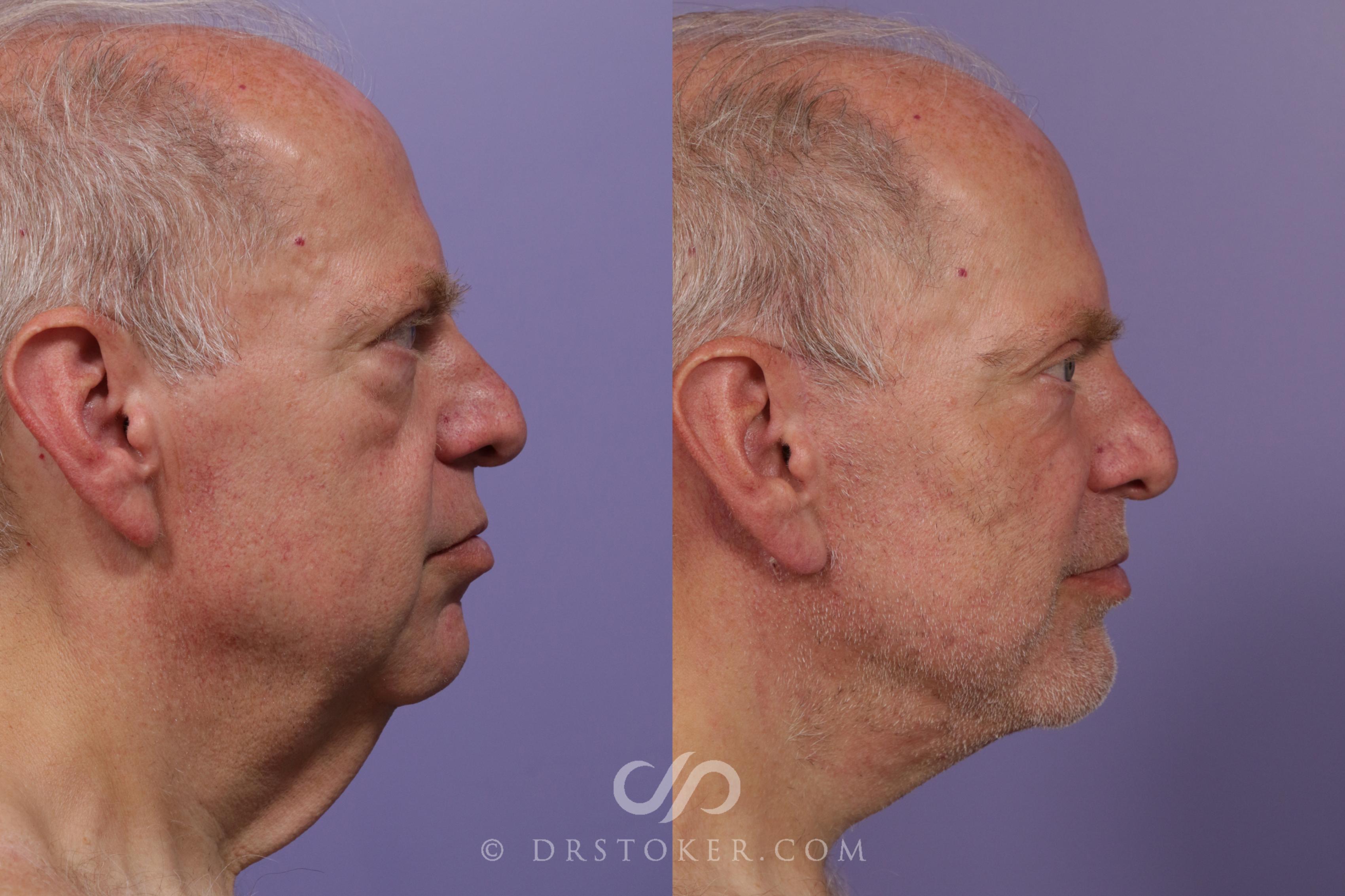 Before & After Facelift for Men Case 1734 View #1 View in Marina del Rey, CA