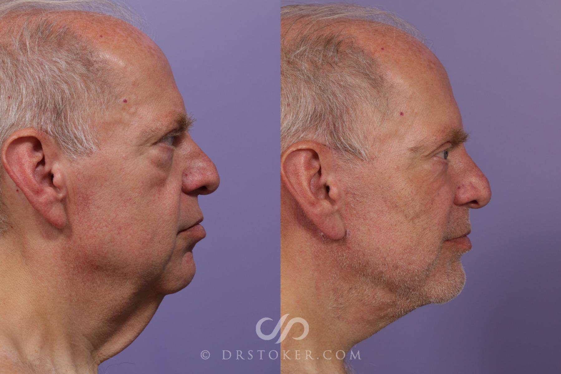 Before & After Neck Lift - Traceless Neck Lift  Case 1734 View #1 View in Los Angeles, CA