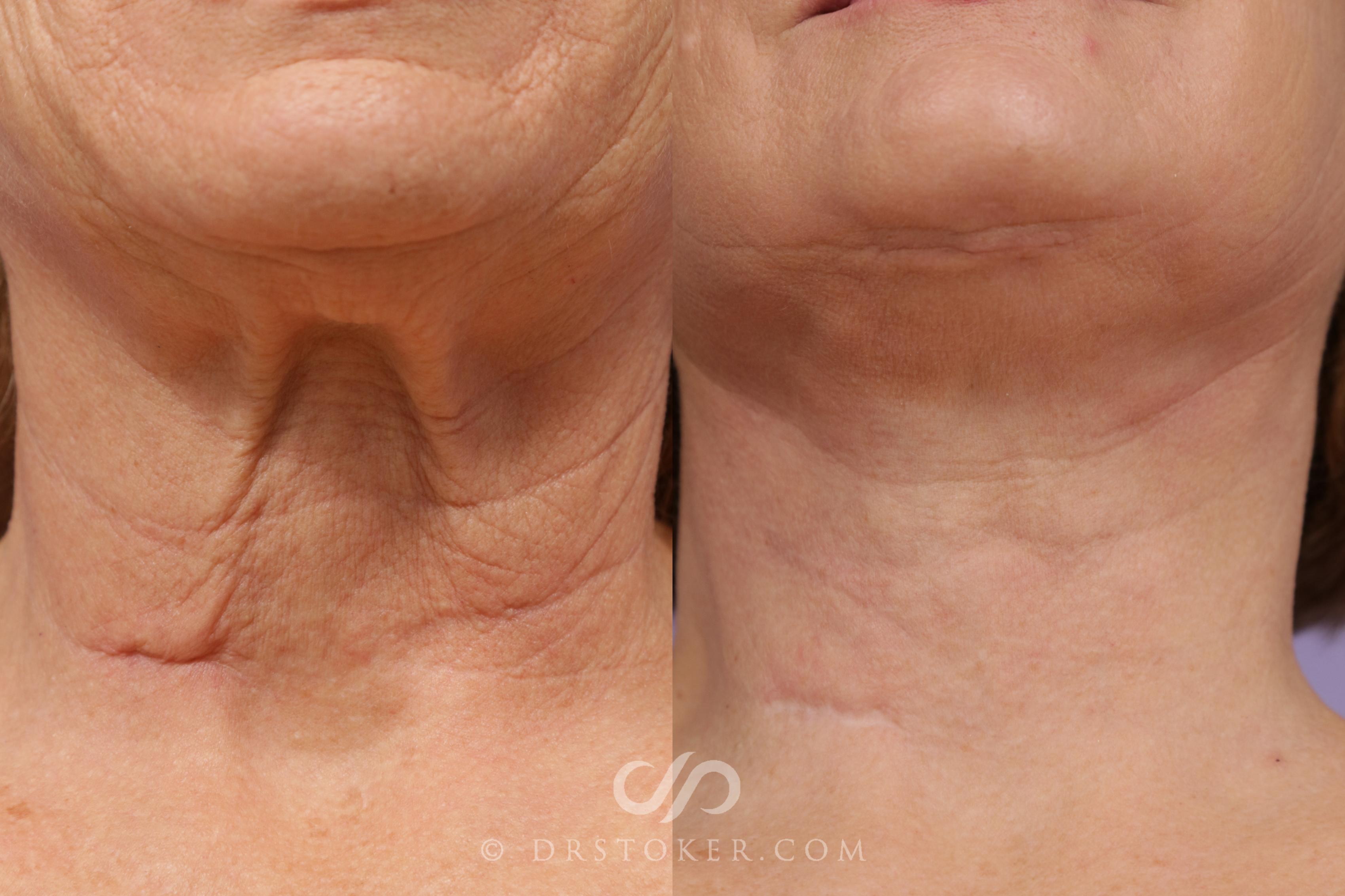 Before & After Neck Lift - Traceless Neck Lift  Case 1737 View #1 View in Los Angeles, CA