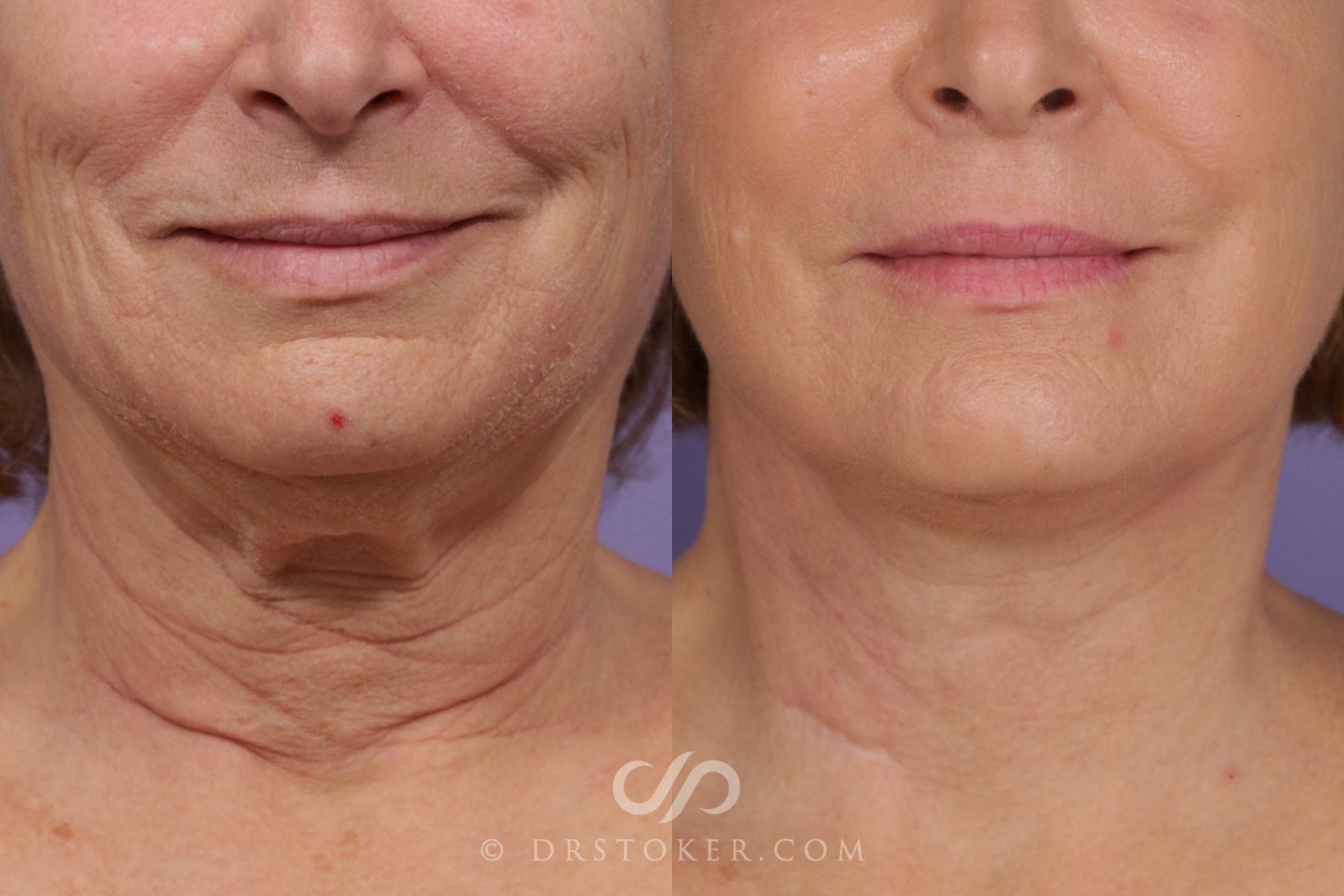 Before & After Neck Lift - Traceless Neck Lift  Case 1737 View #2 View in Los Angeles, CA
