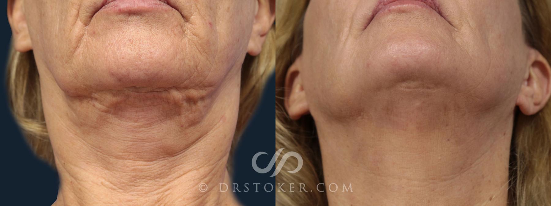 Before & After Neck Lift - Traceless Neck Lift  Case 2086 Front View in Los Angeles, CA