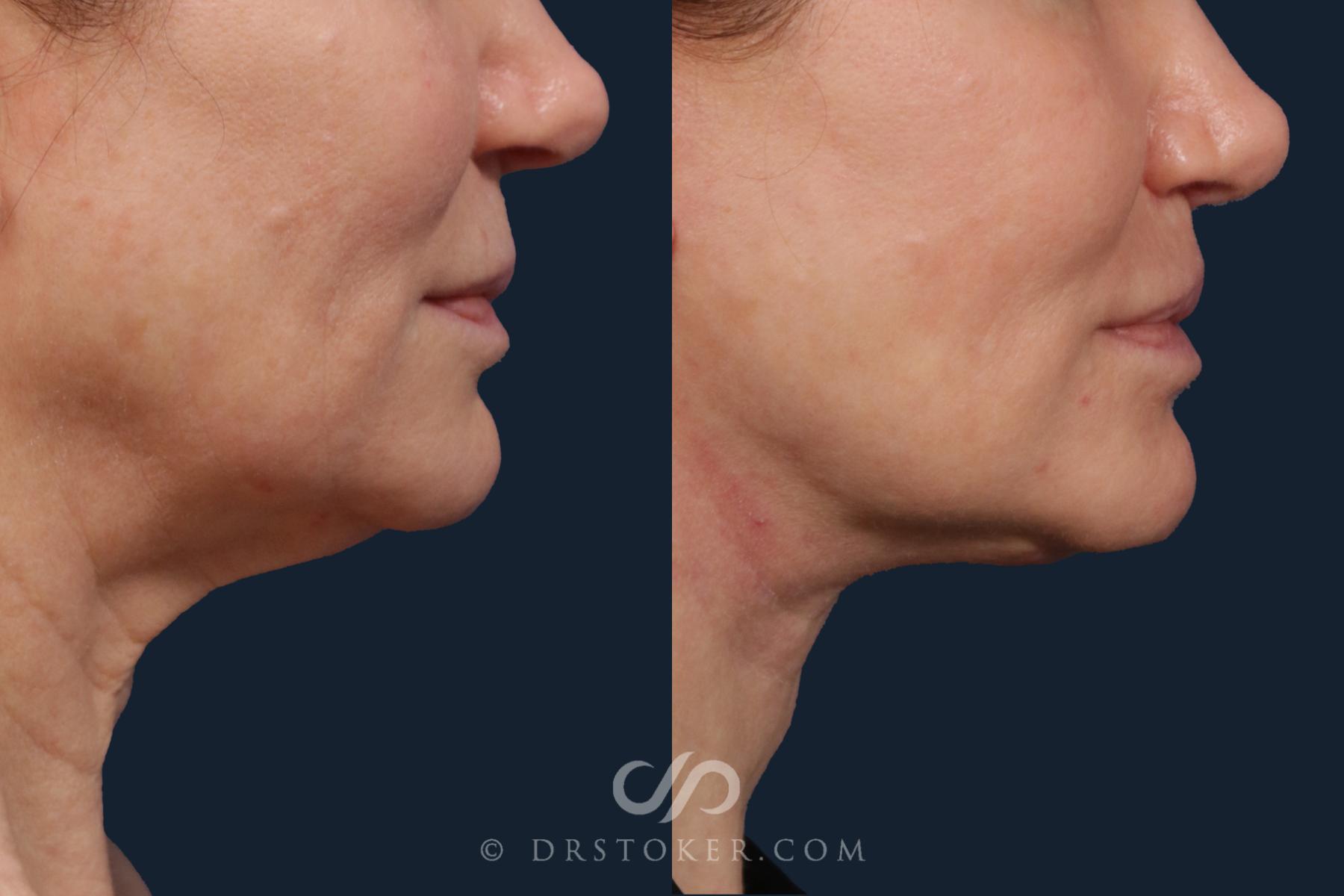 Before & After Neck Lift - Traceless Neck Lift  Case 2103 Right Side View in Los Angeles, CA