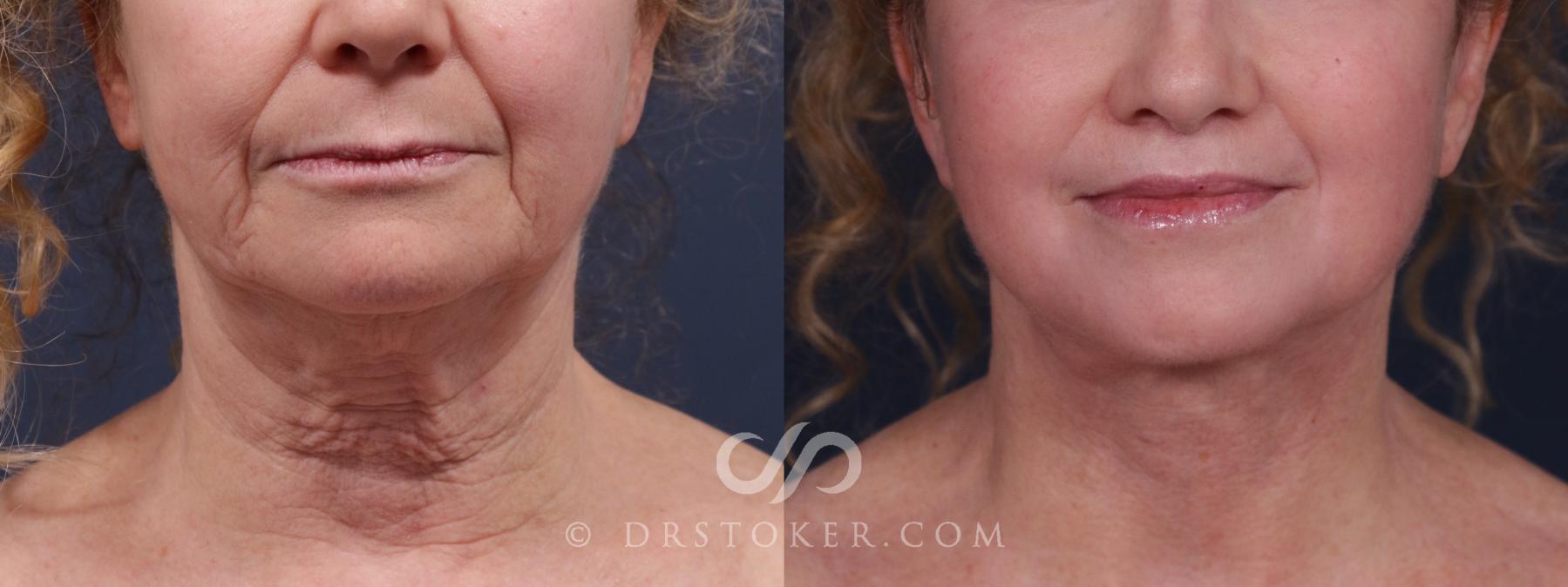 Before & After Neck Lift - Traceless Neck Lift  Case 2158 Front View in Los Angeles, CA