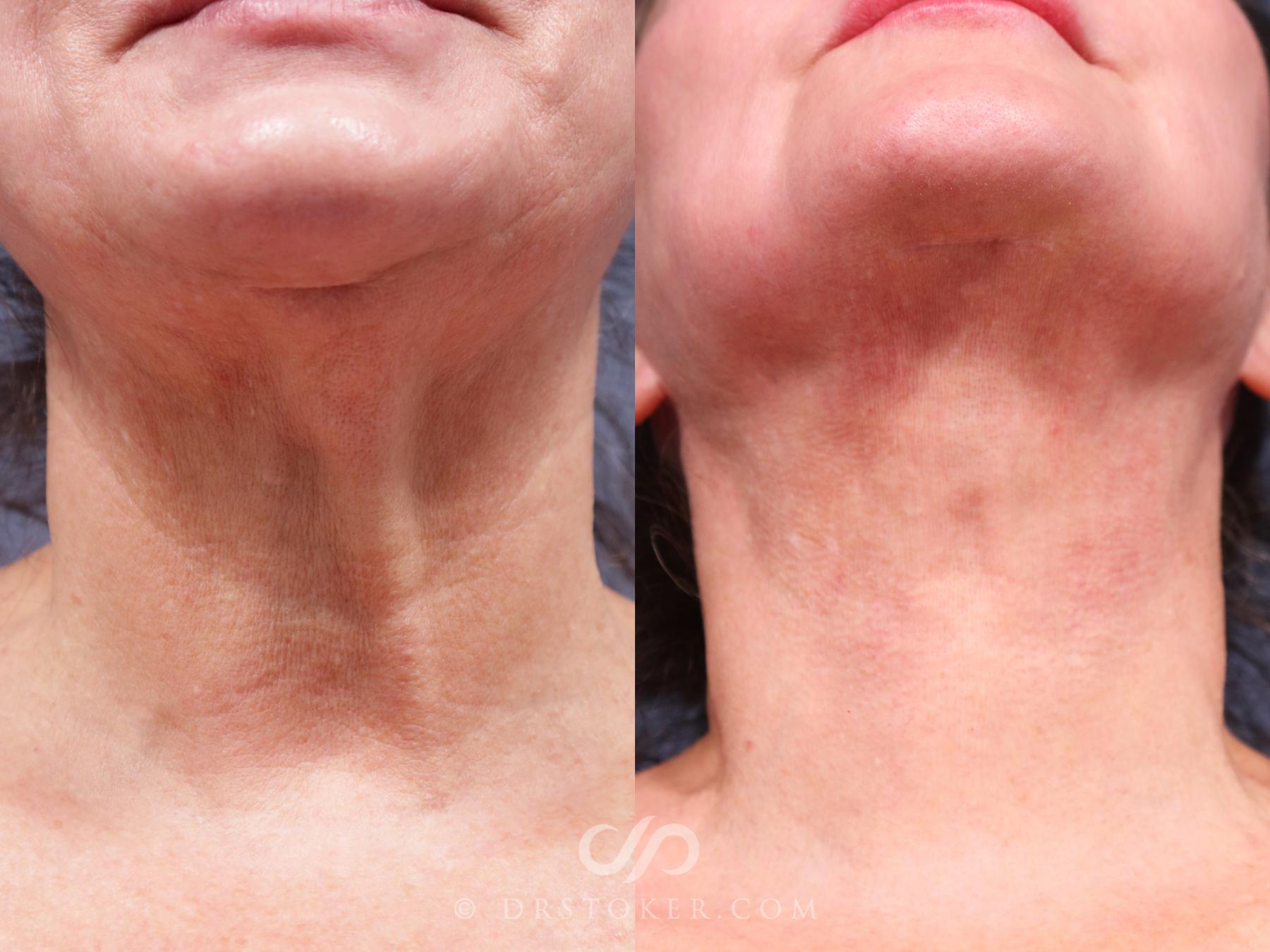 Before & After Neck Lift - Traceless Neck Lift  Case 2315 Front View in Los Angeles, CA