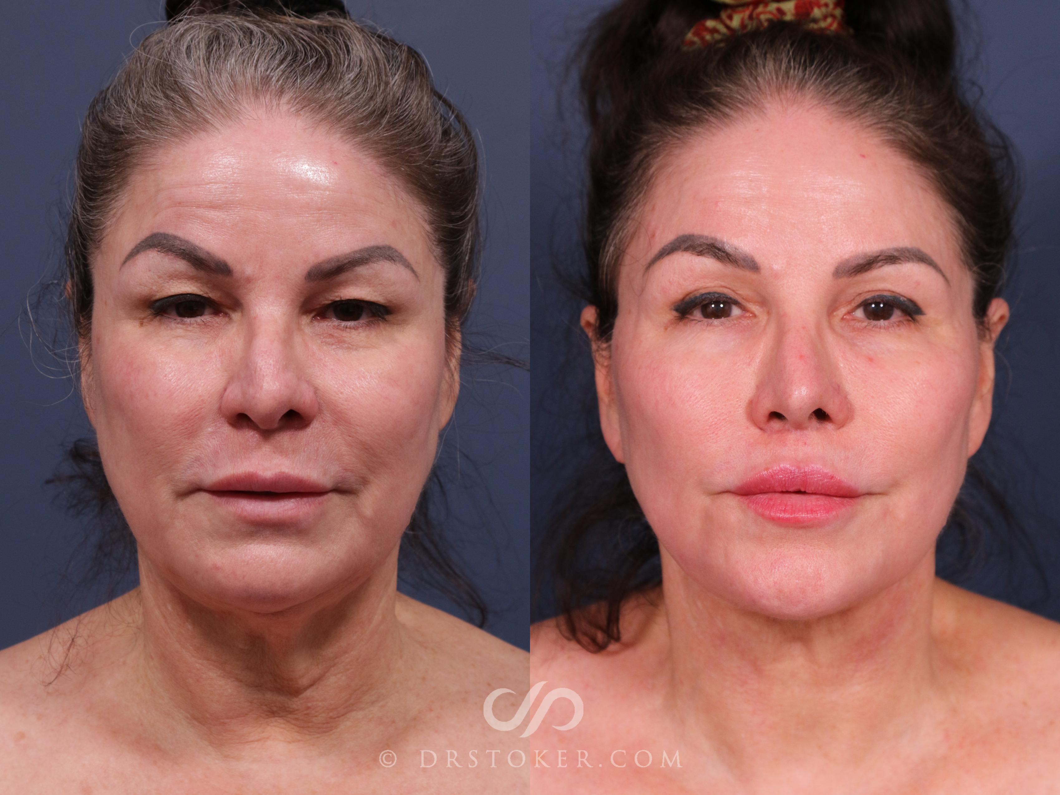 Before & After Neck Lift - Traceless Neck Lift  Case 2316 Front View in Los Angeles, CA