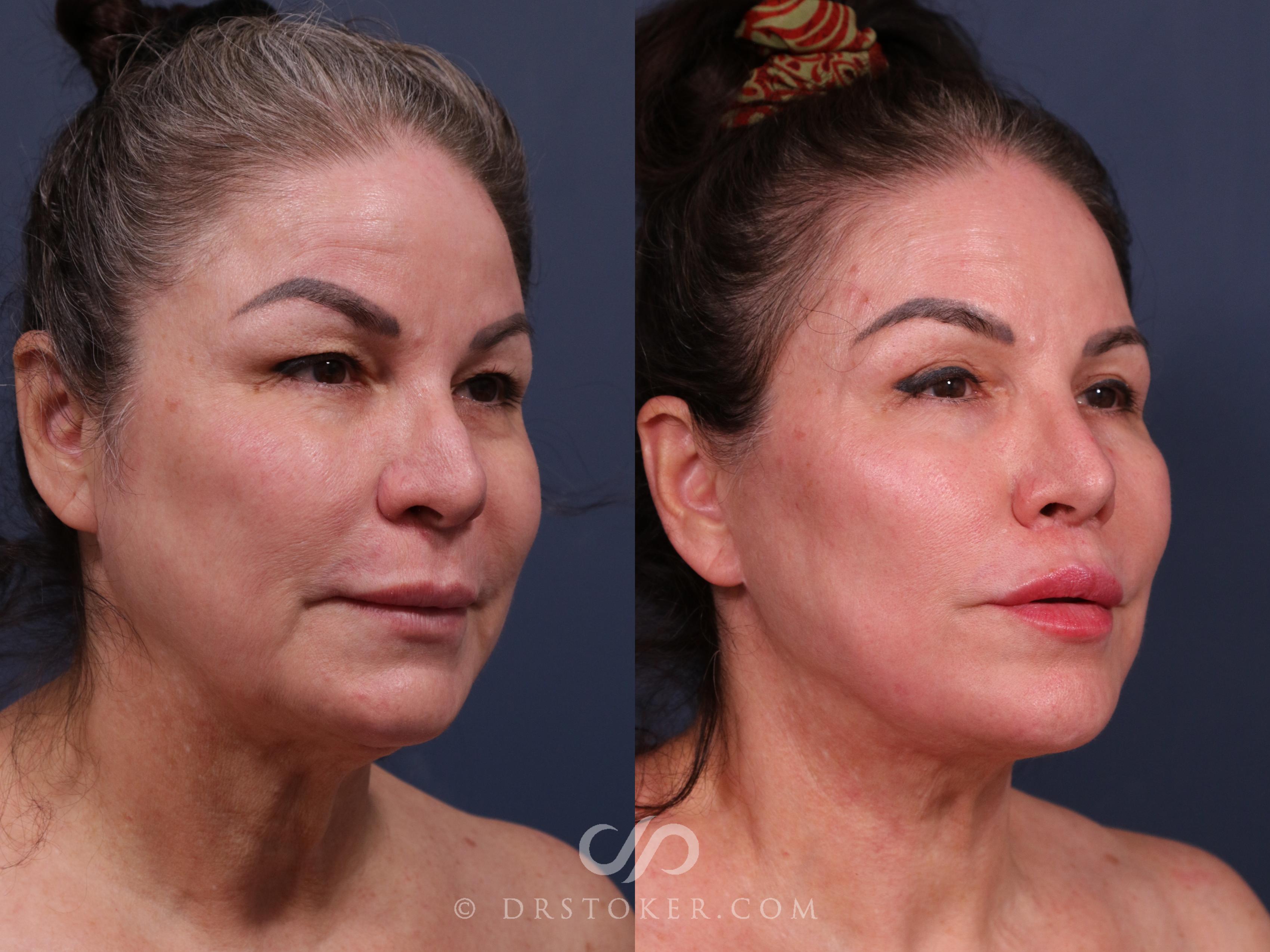 Before & After Neck Lift - Traceless Neck Lift  Case 2316 Right Oblique View in Los Angeles, CA