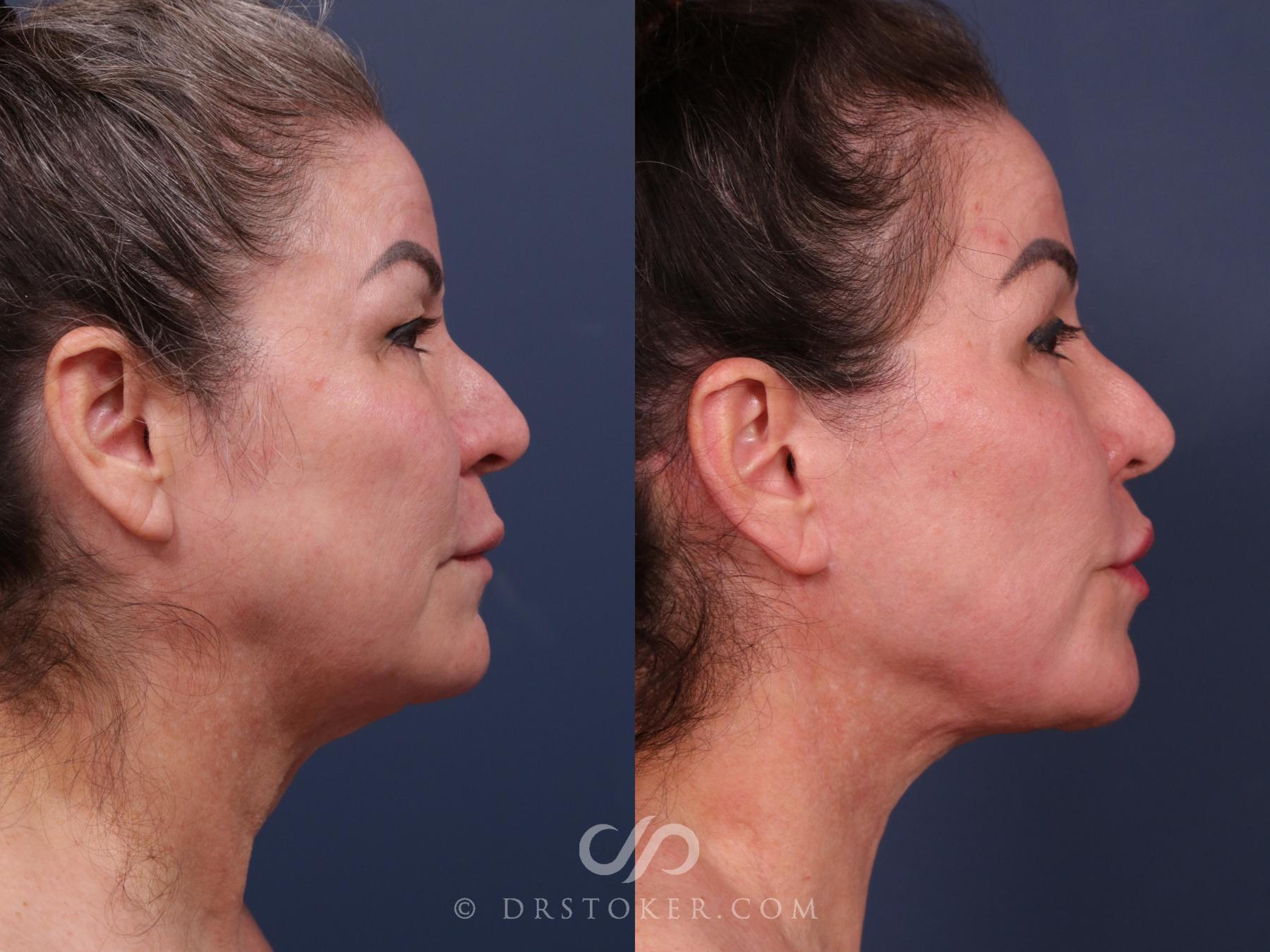 Before & After Neck Lift - Traceless Neck Lift  Case 2316 Right Side View in Los Angeles, CA