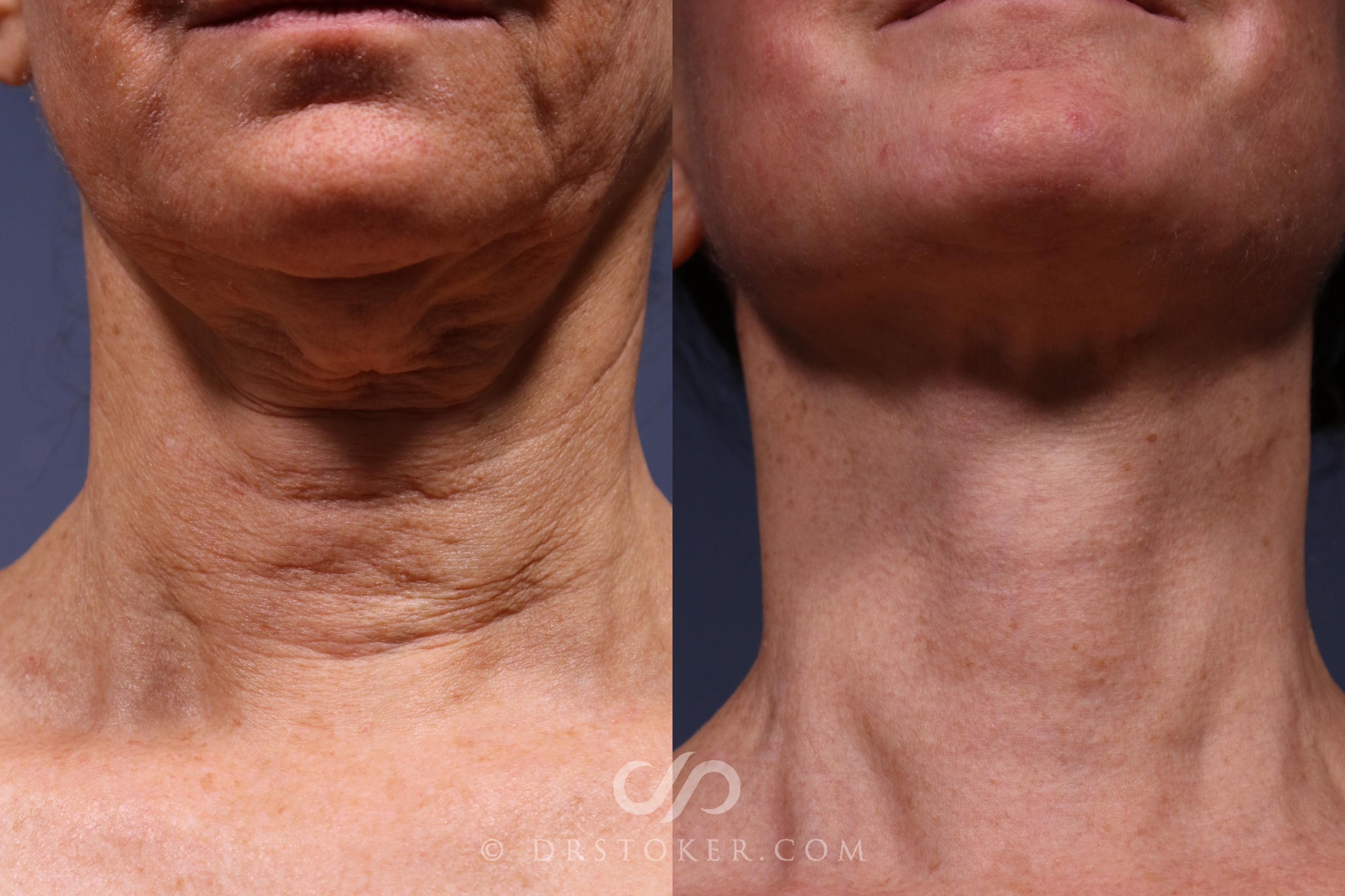 Before & After Neck Lift - Traceless Neck Lift  Case 2376 Front View in Los Angeles, CA