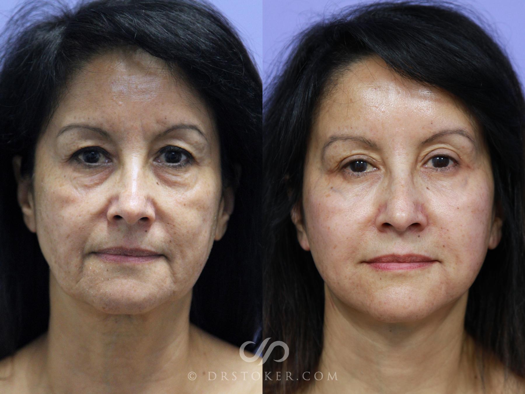 Before & After Neck Lift - Traceless Neck Lift  Case 808 View #1 View in Los Angeles, CA