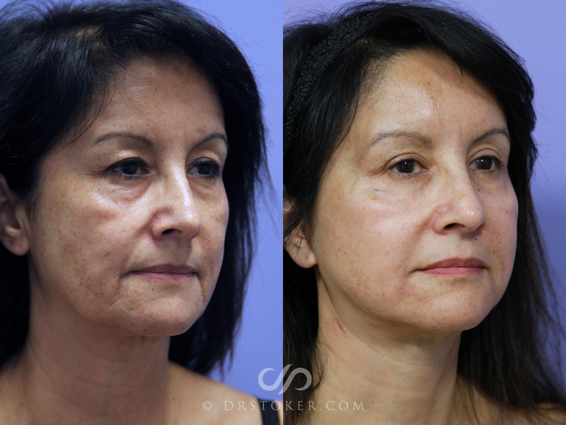 Before & After Neck Lift - Traceless Neck Lift  Case 808 View #2 View in Los Angeles, CA