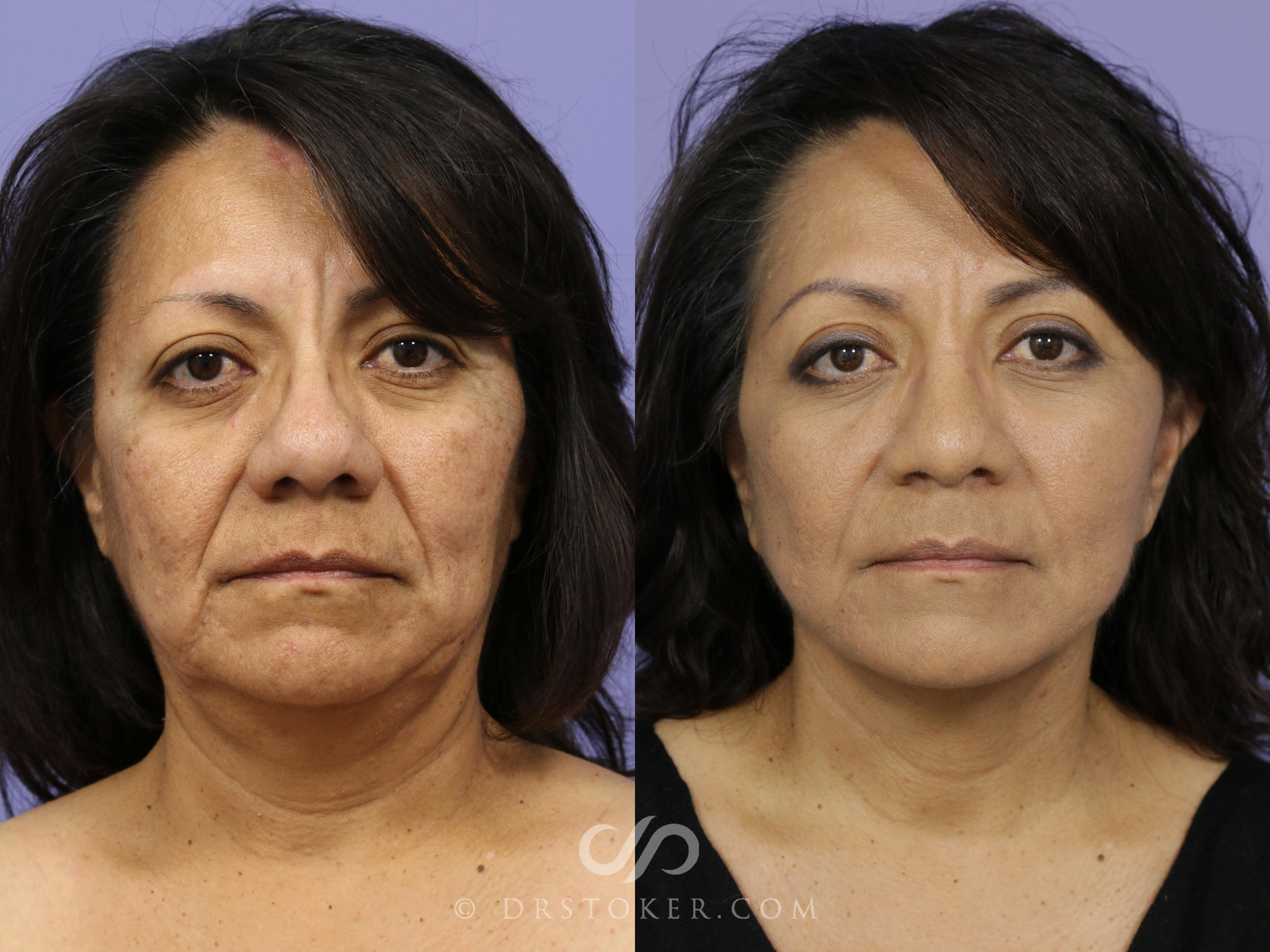 Before & After Neck Lift - Traceless Neck Lift  Case 811 View #1 View in Los Angeles, CA