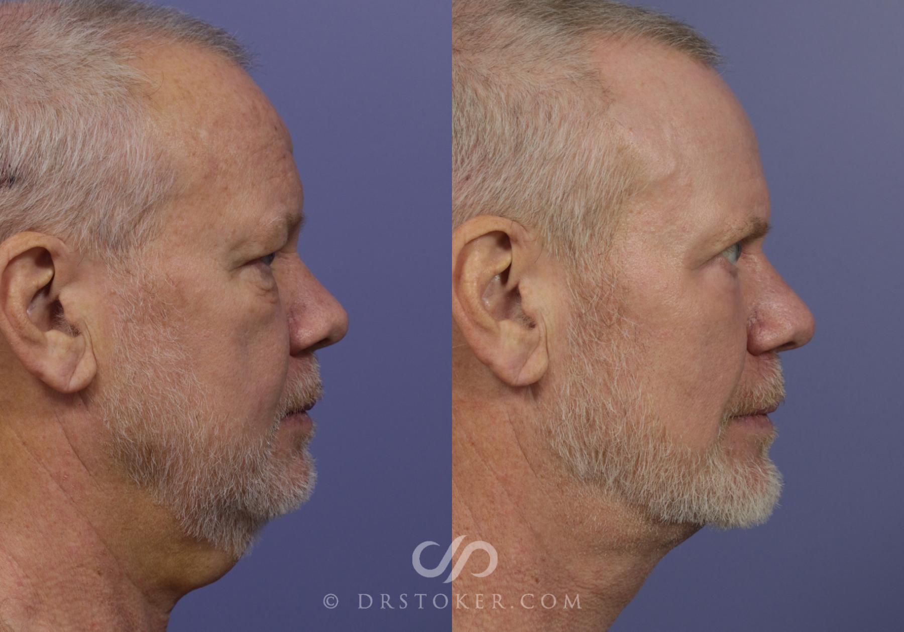 Before & After Neck Lift - Traceless Neck Lift  Case 824 View #4 View in Los Angeles, CA