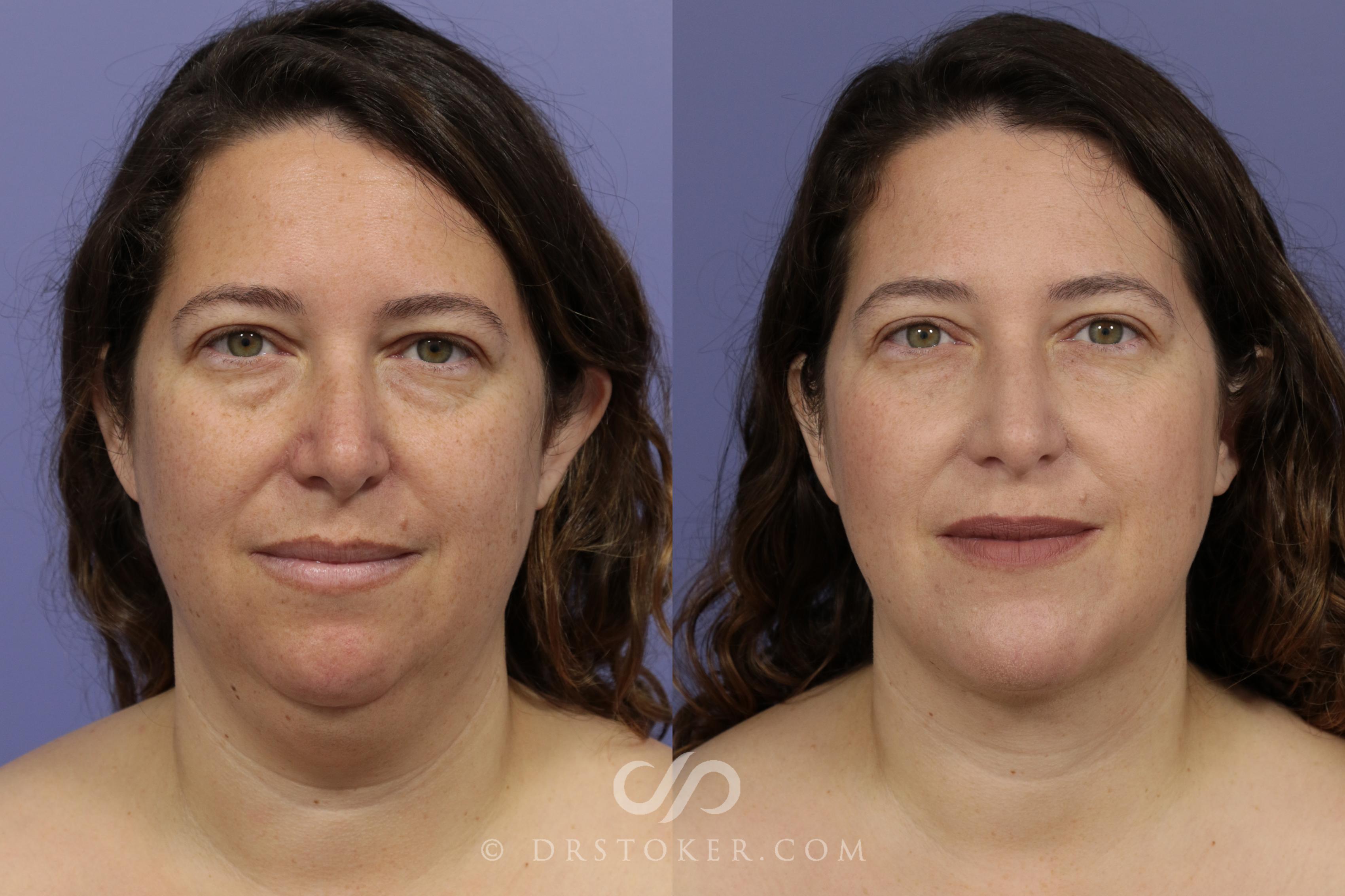 Before & After Neck Lift - Traceless Neck Lift  Case 825 View #1 View in Los Angeles, CA