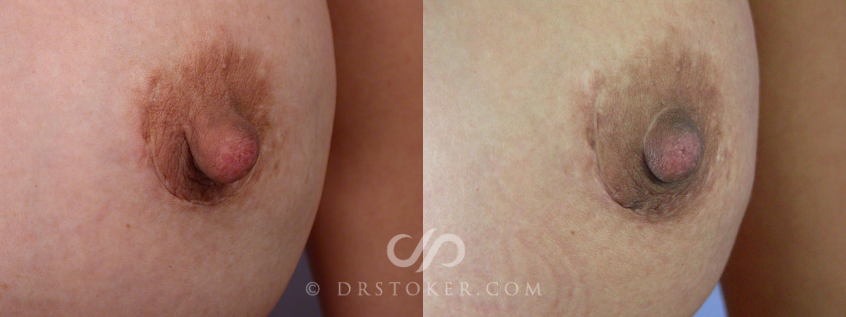 Before & After Nipple - Areola Correction Case 229 View #1 View in Los Angeles, CA