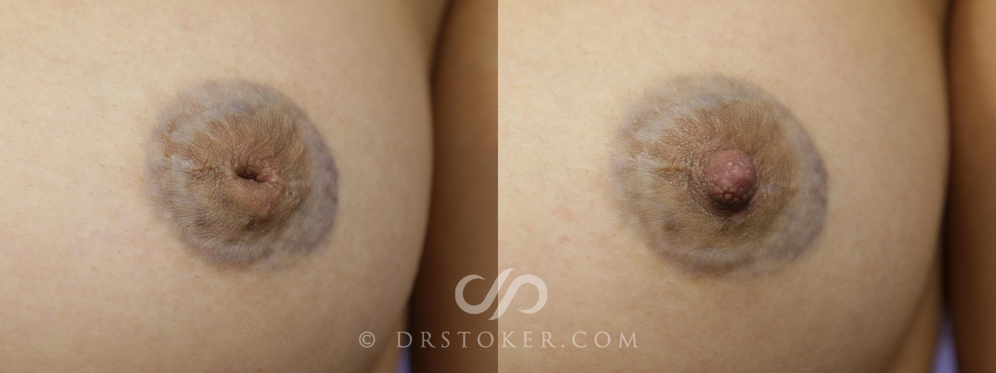 Before & After Nipple - Inversion Correction Case 1354 View #1 View in Los Angeles, CA