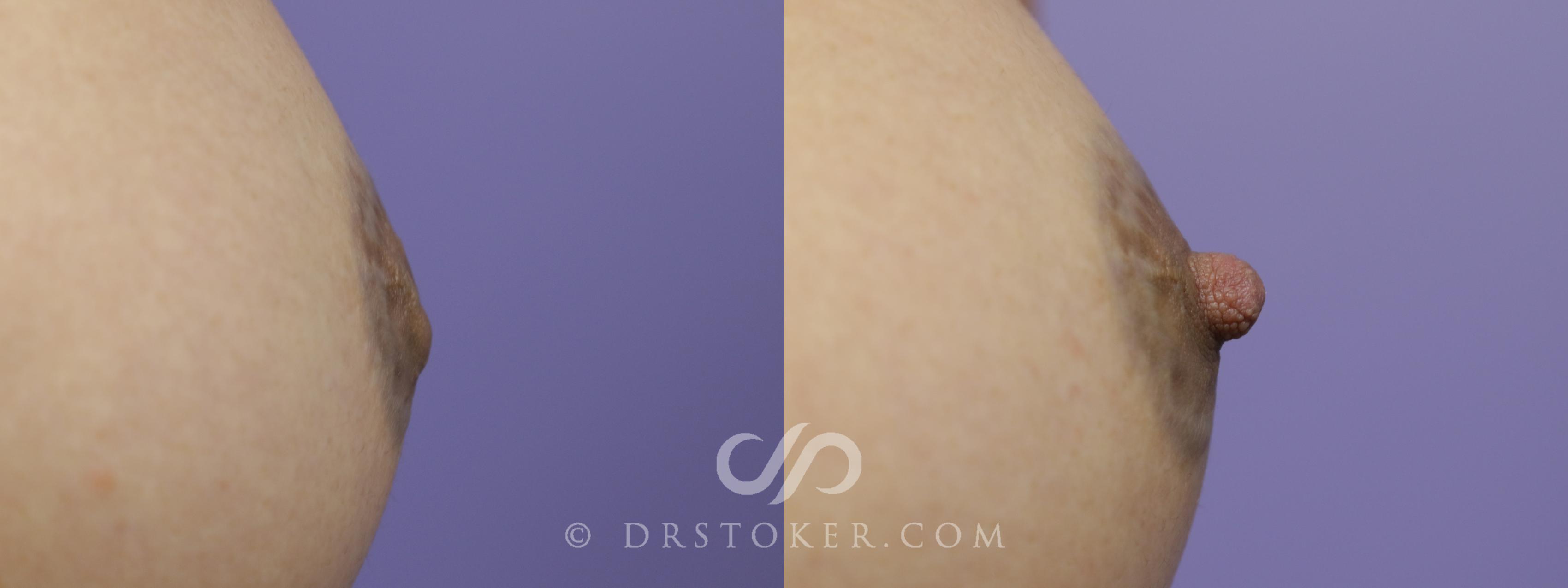 Before & After Nipple - Inversion Correction Case 1355 View #1 View in Los Angeles, CA