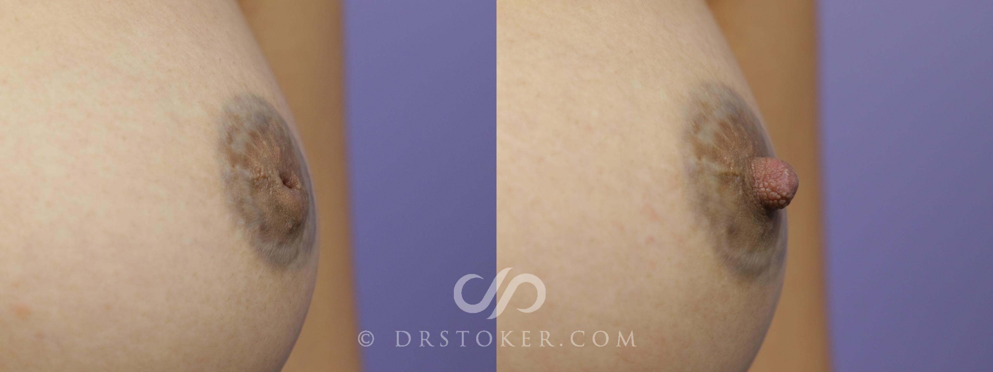Before & After Nipple - Inversion Correction Case 1356 View #1 View in Los Angeles, CA