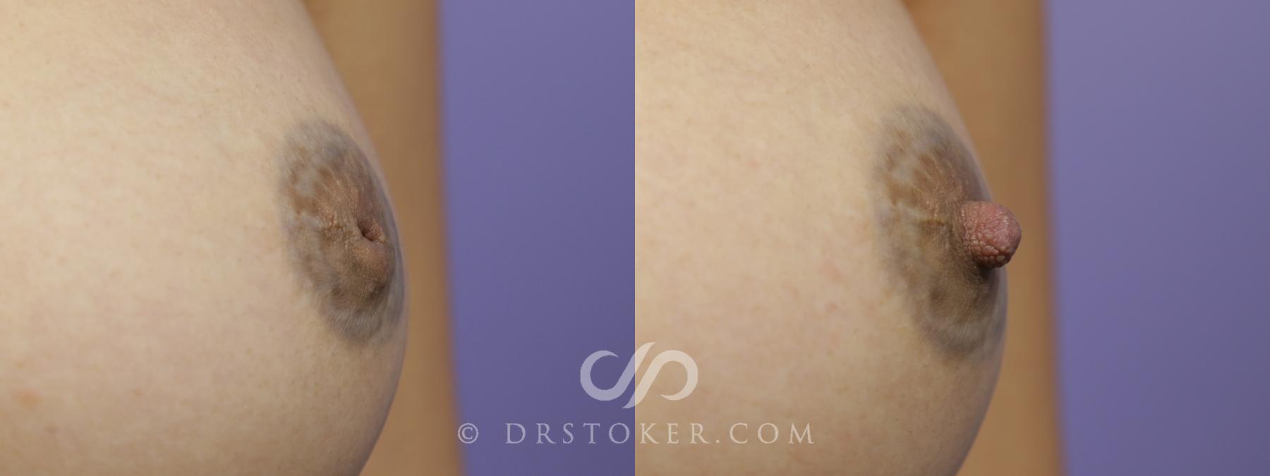 Before & After Nipple - Inversion Correction Case 1356 View #1 View in Los Angeles, CA