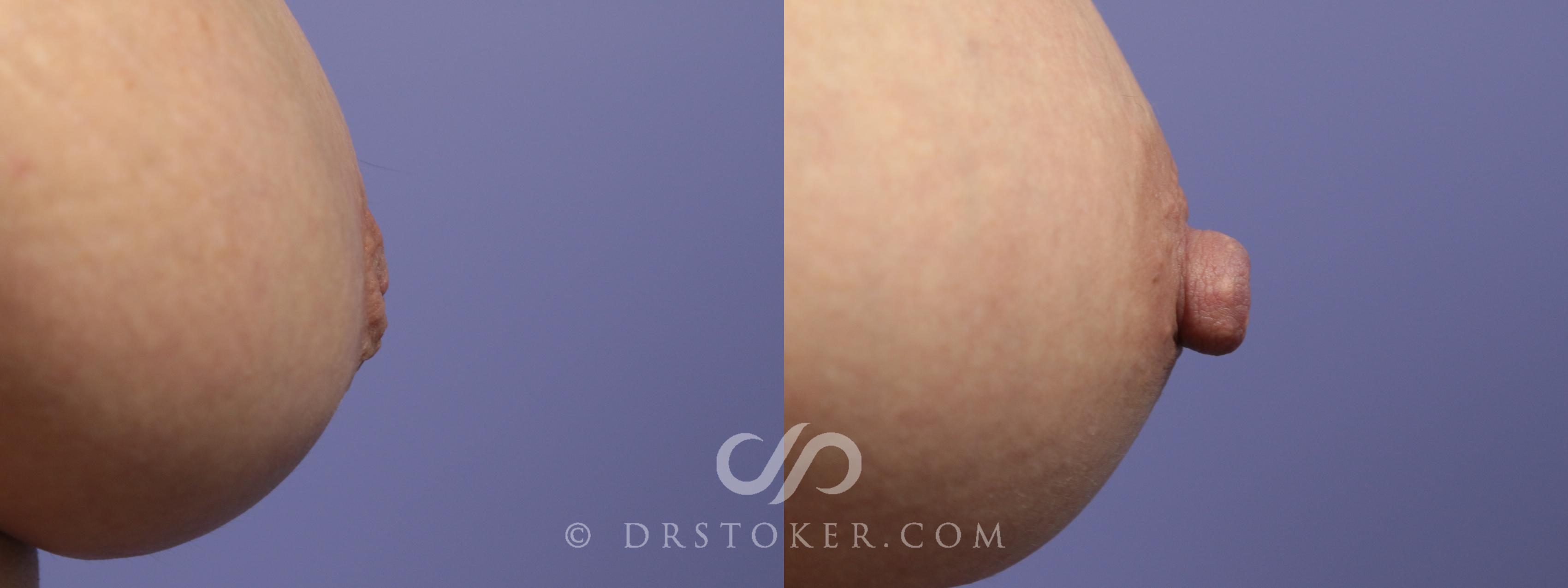 Before & After Nipple - Inversion Correction Case 1357 View #1 View in Los Angeles, CA