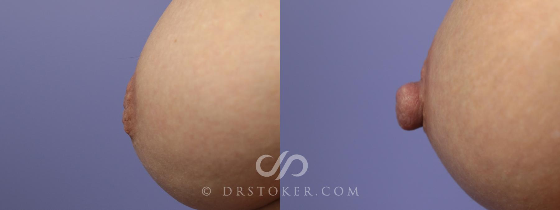 Before & After Nipple - Inversion Correction Case 1358 View #1 View in Los Angeles, CA