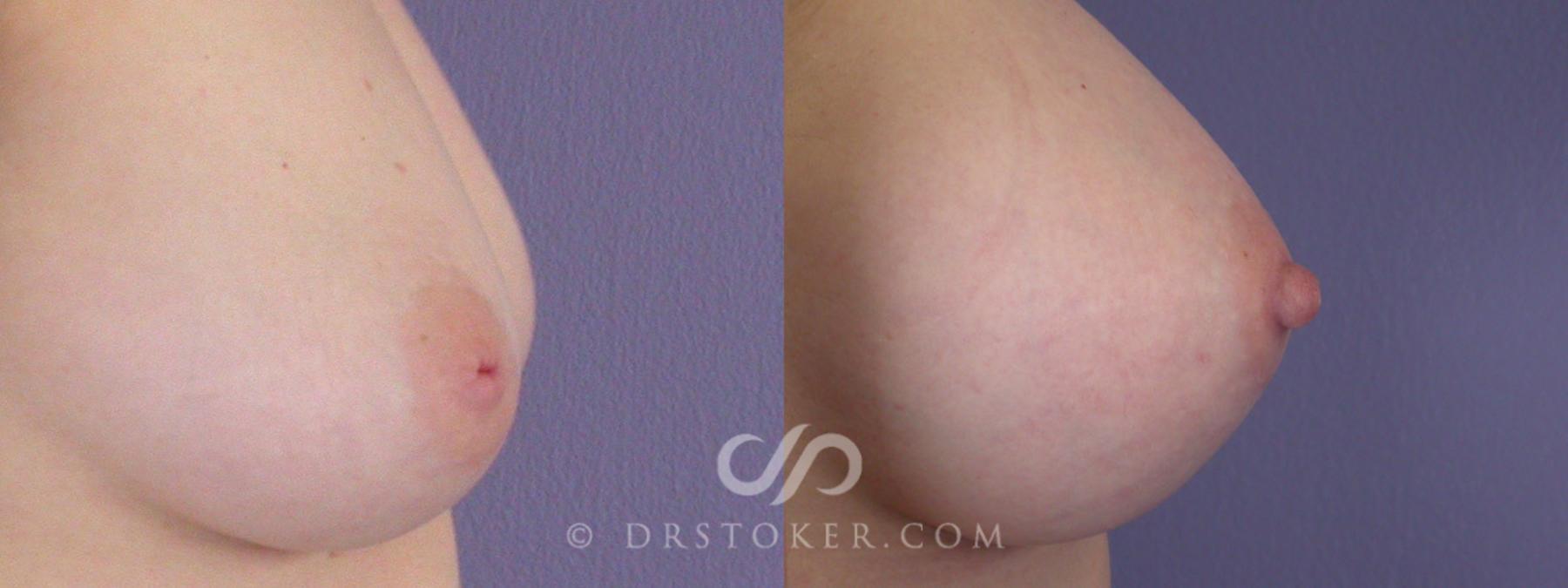 Before & After Nipple - Inversion Correction Case 227 View #2 View in Los Angeles, CA