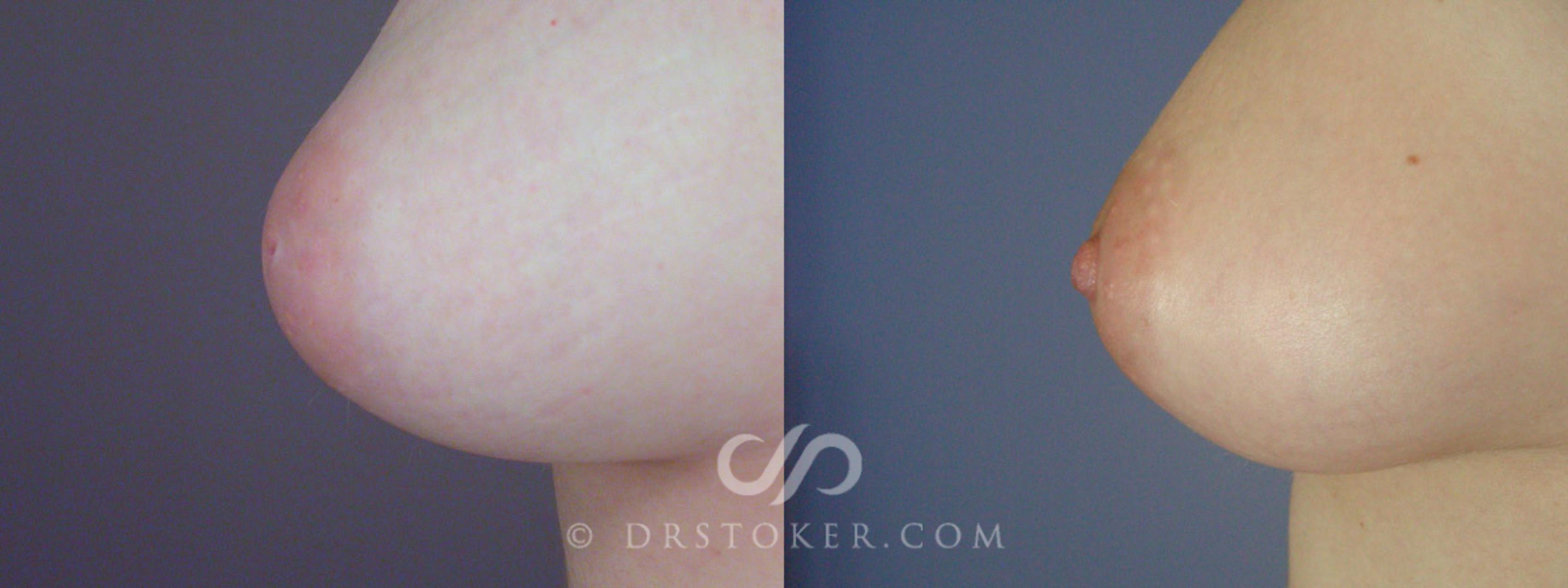 Before & After Nipple - Inversion Correction Case 228 View #1 View in Los Angeles, CA