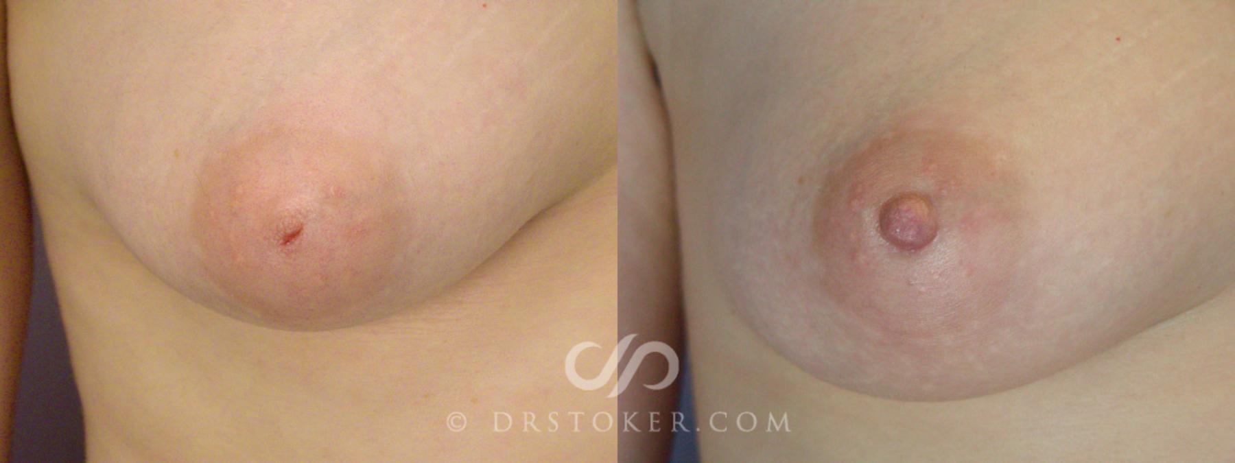 Before & After Nipple - Inversion Correction Case 230 View #1 View in Los Angeles, CA