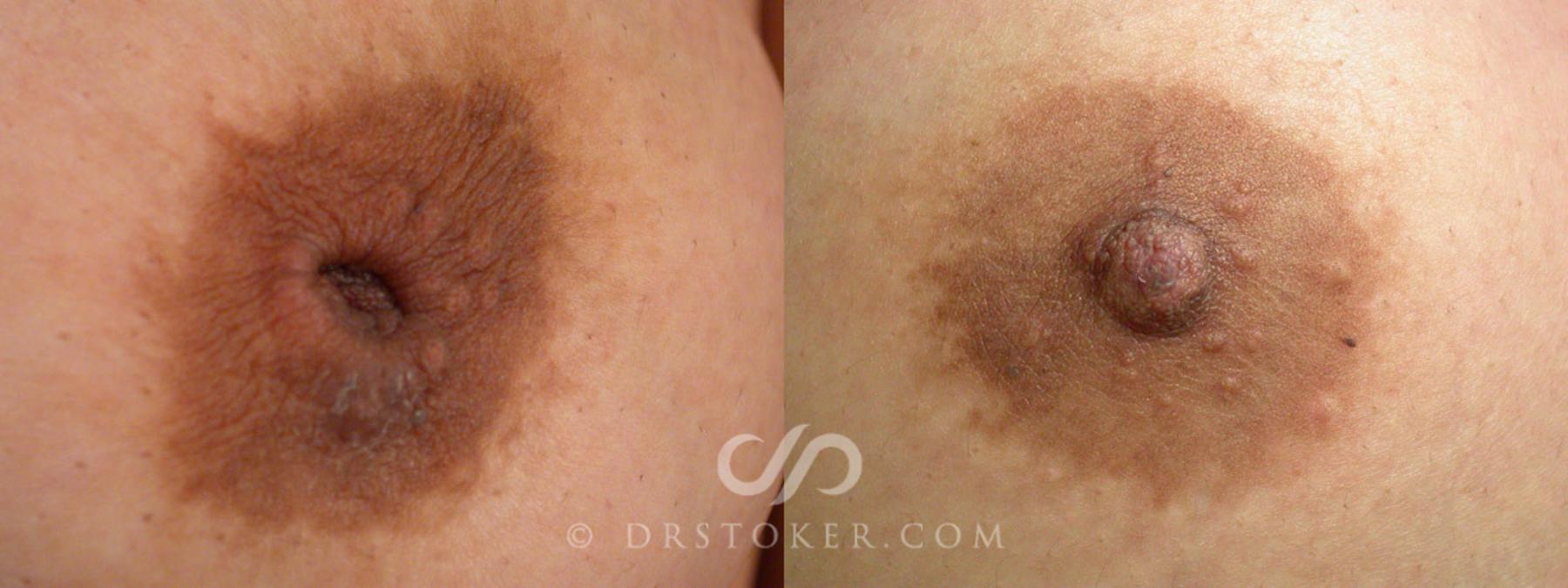 Before & After Nipple - Inversion Correction Case 231 View #1 View in Los Angeles, CA