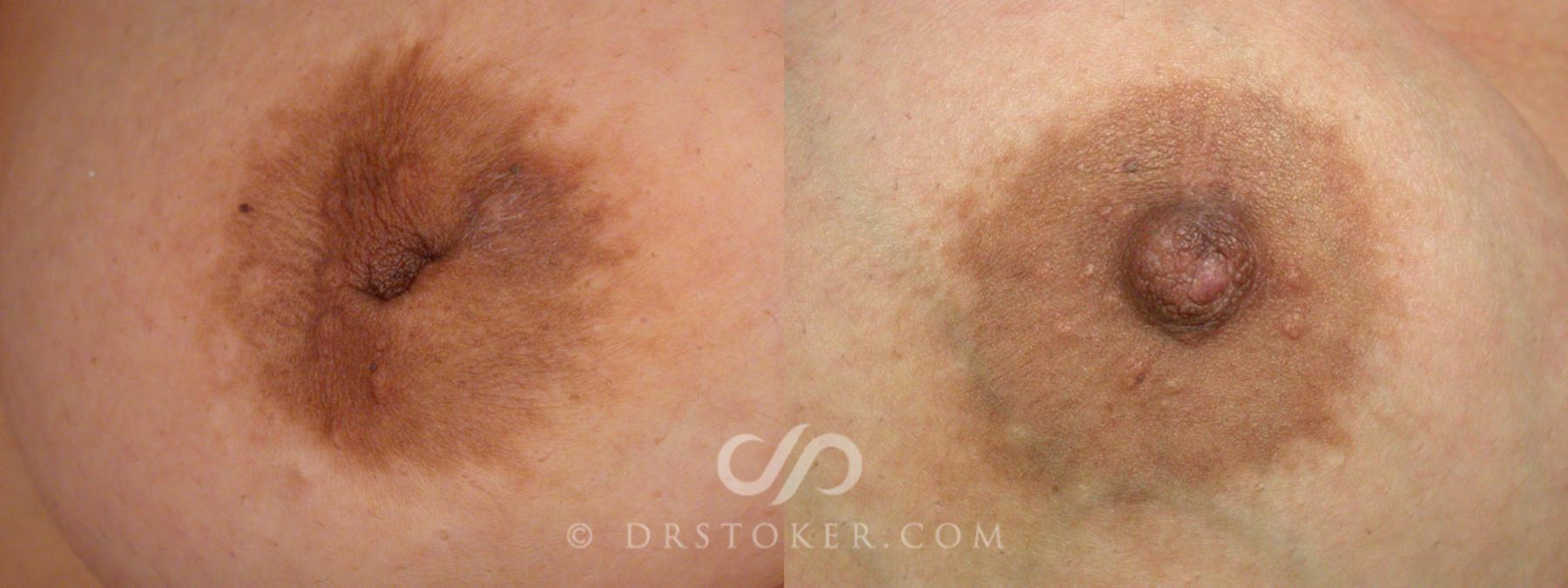 Before & After Nipple - Inversion Correction Case 231 View #2 View in Los Angeles, CA