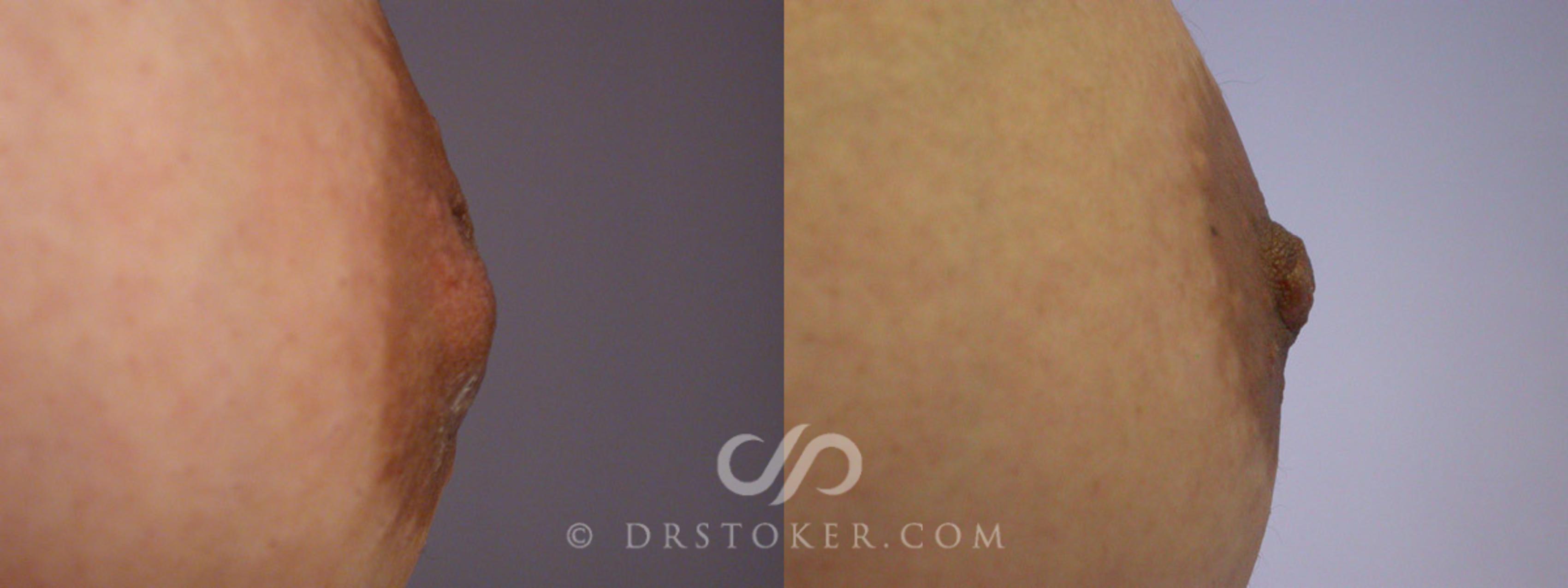 Before & After Nipple - Inversion Correction Case 231 View #3 View in Los Angeles, CA