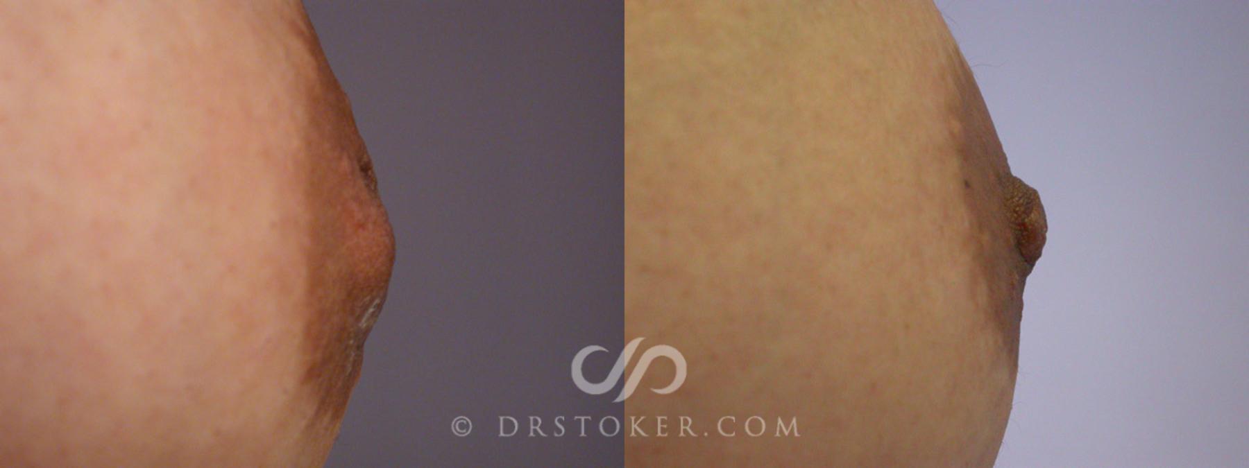 Before & After Nipple - Inversion Correction Case 231 View #3 View in Los Angeles, CA