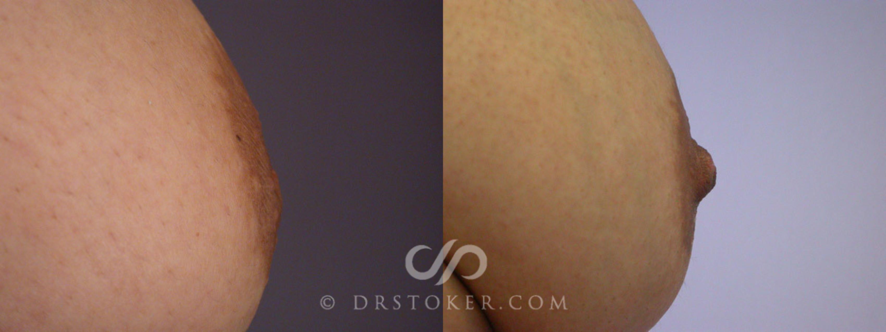 Before & After Nipple - Inversion Correction Case 231 View #4 View in Los Angeles, CA