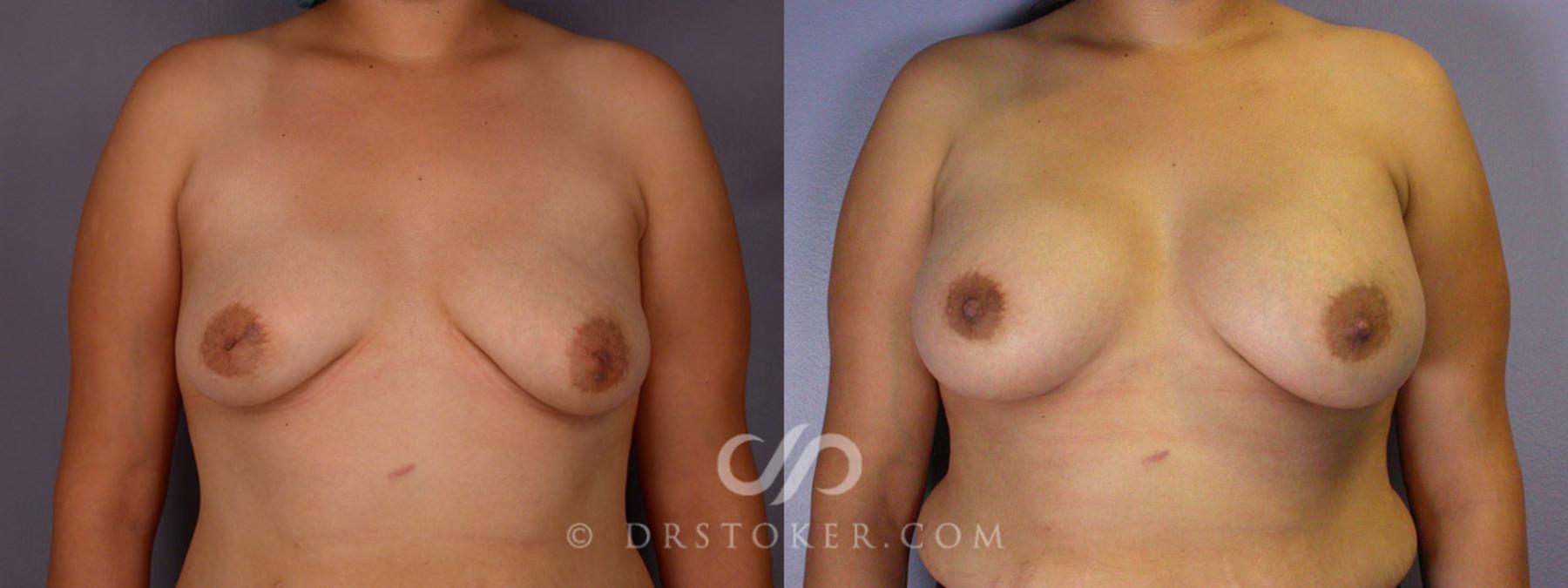 Before & After Nipple - Inversion Correction Case 231 View #5 View in Los Angeles, CA