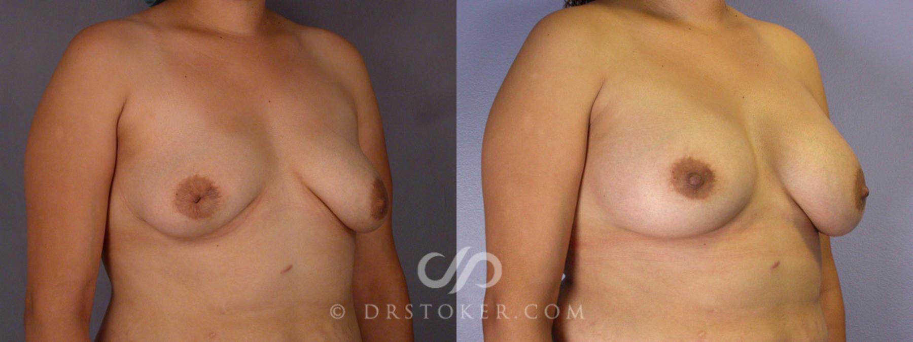Before & After Nipple - Inversion Correction Case 231 View #6 View in Los Angeles, CA