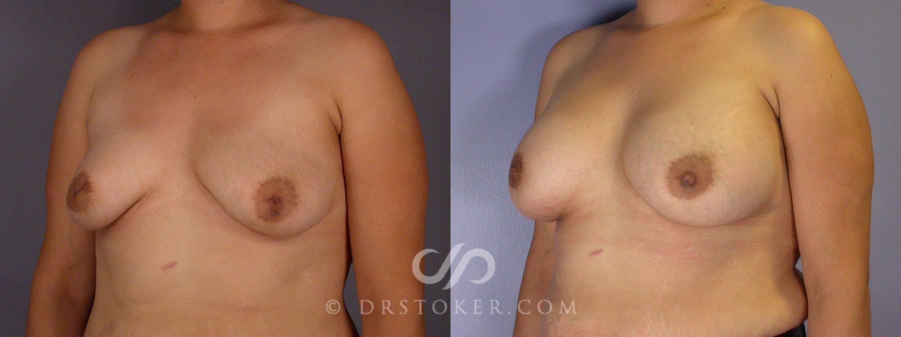 Before & After Nipple - Inversion Correction Case 231 View #7 View in Los Angeles, CA