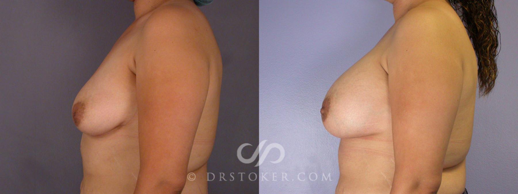 Before & After Nipple - Inversion Correction Case 231 View #9 View in Los Angeles, CA
