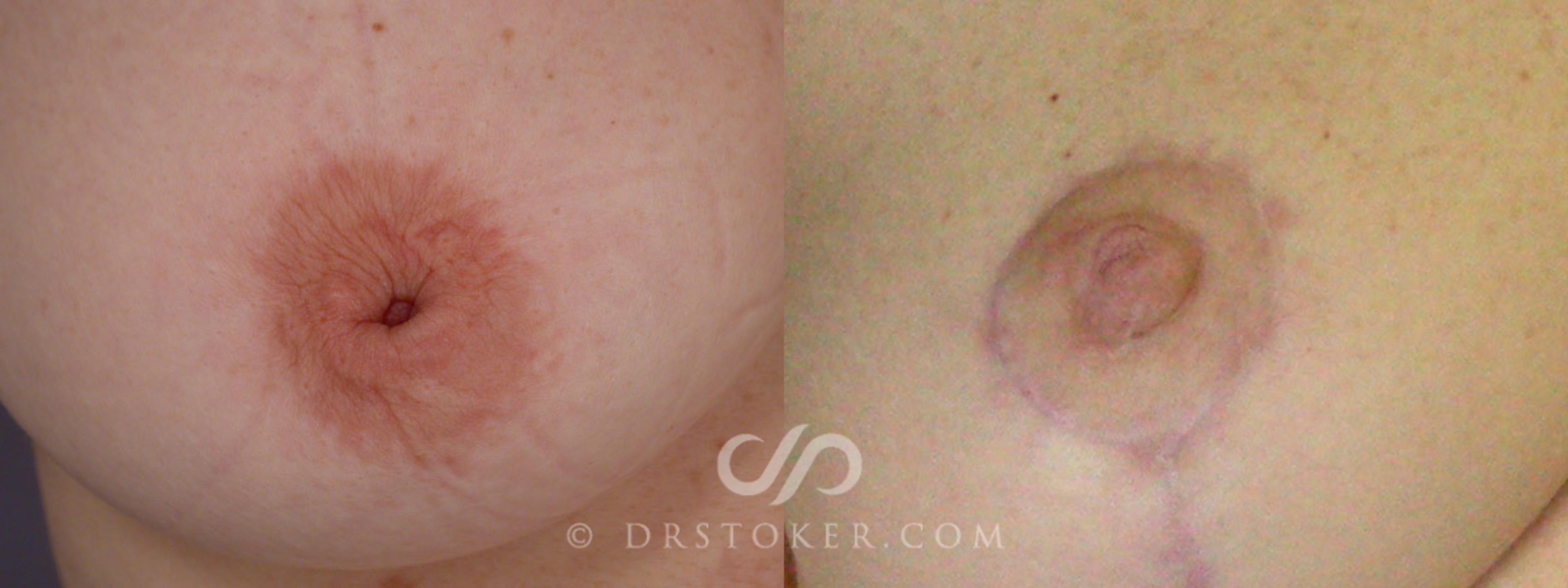 Before & After Nipple - Inversion Correction Case 232 View #1 View in Los Angeles, CA
